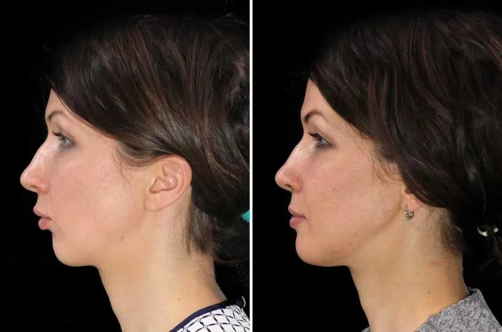 retrognatismo mandibular