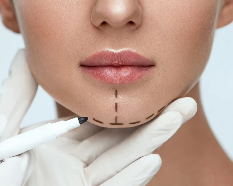 queixo retraído como corrigir