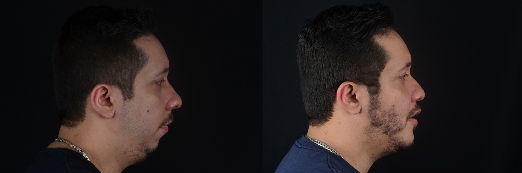 cirurgia ortognática antes e depois exemplo