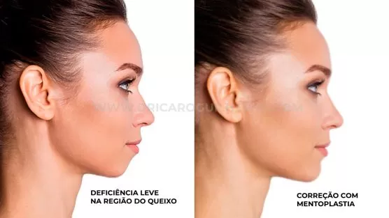Mentoplastia Antes e Depois: Principais Dúvidas [Com Fotos]