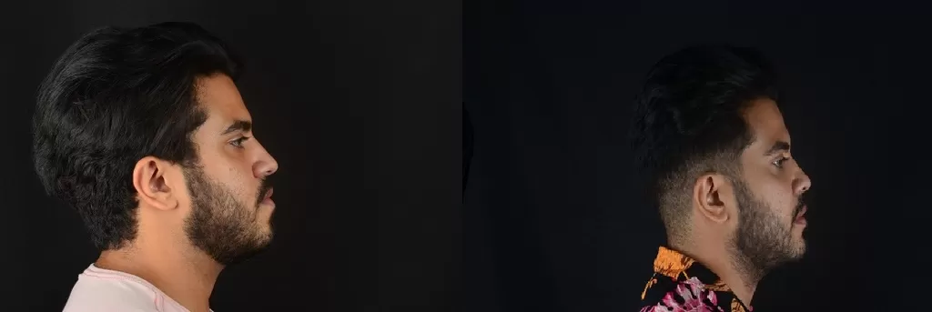 mentoplastia antes e depois