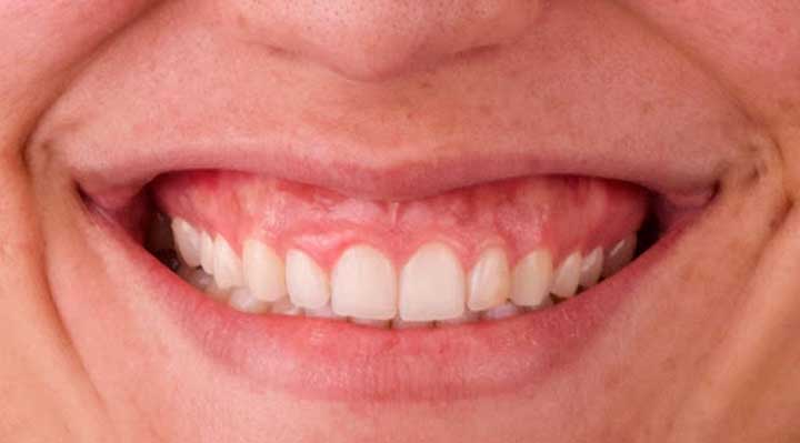 correção de sorriso gengival