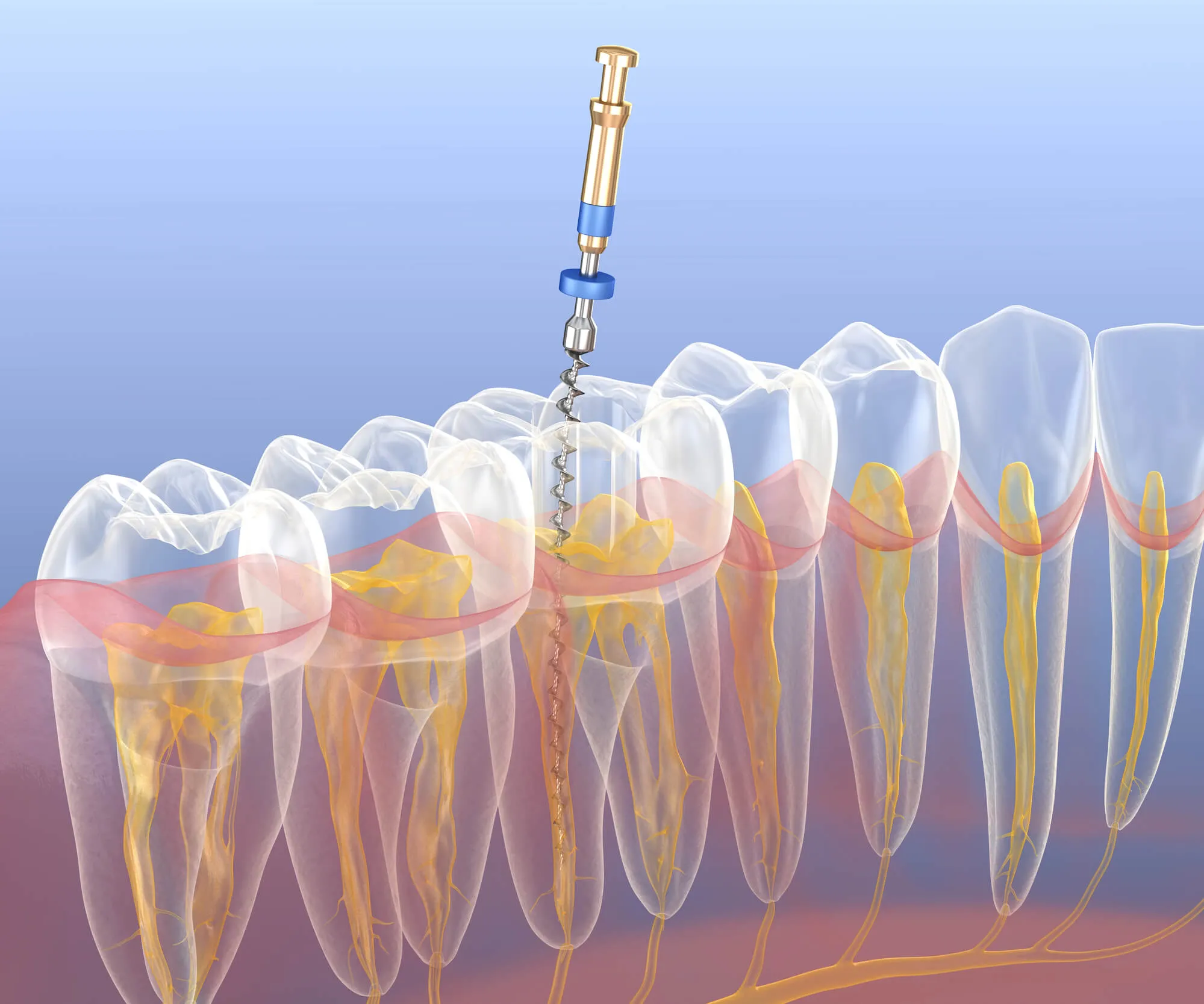 3D image of root canal norristown pa
