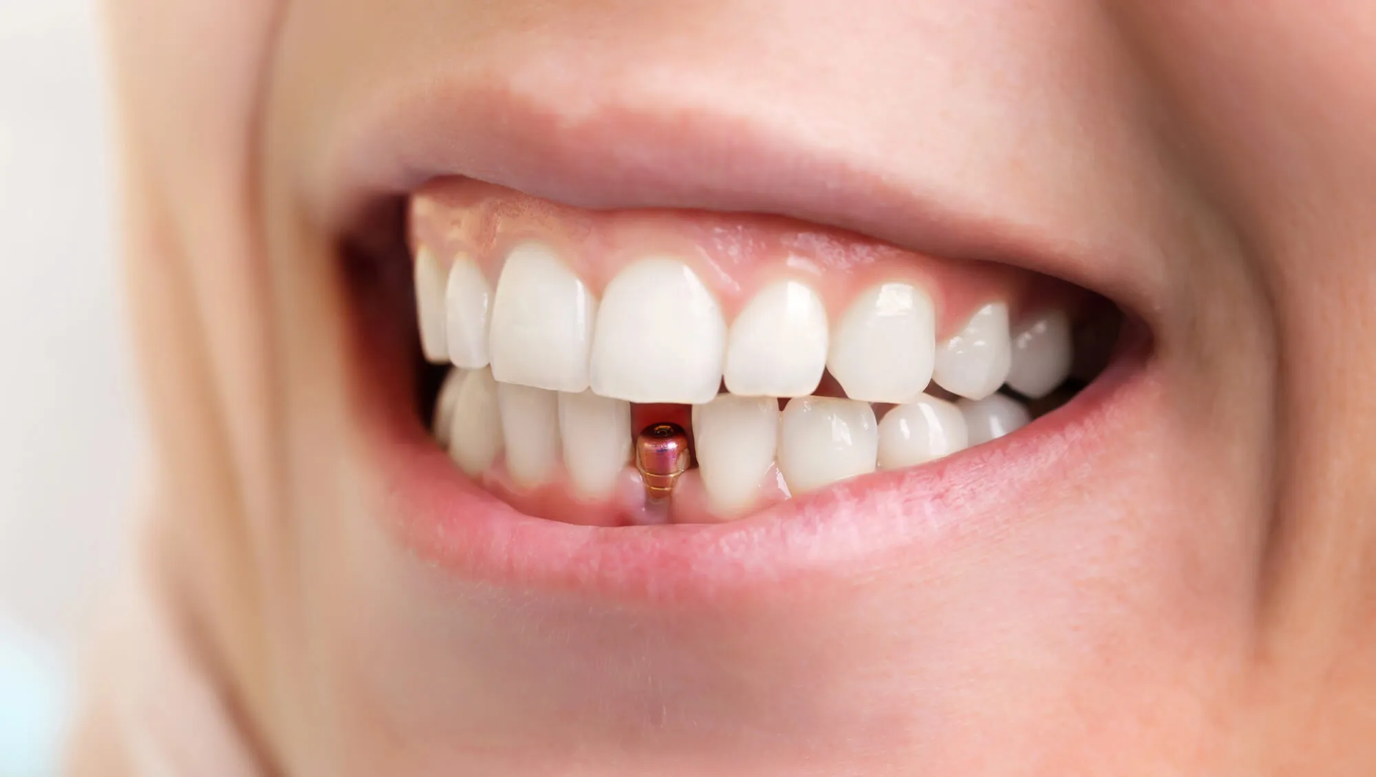 patient with dental implants norristown pa