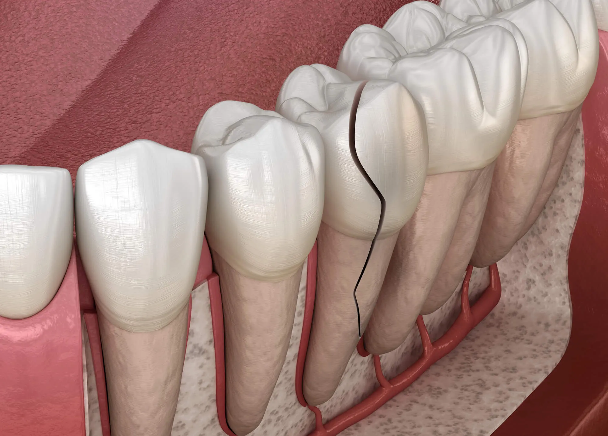 cracked tooth warrants a visit to an emergency dentist norristown pa