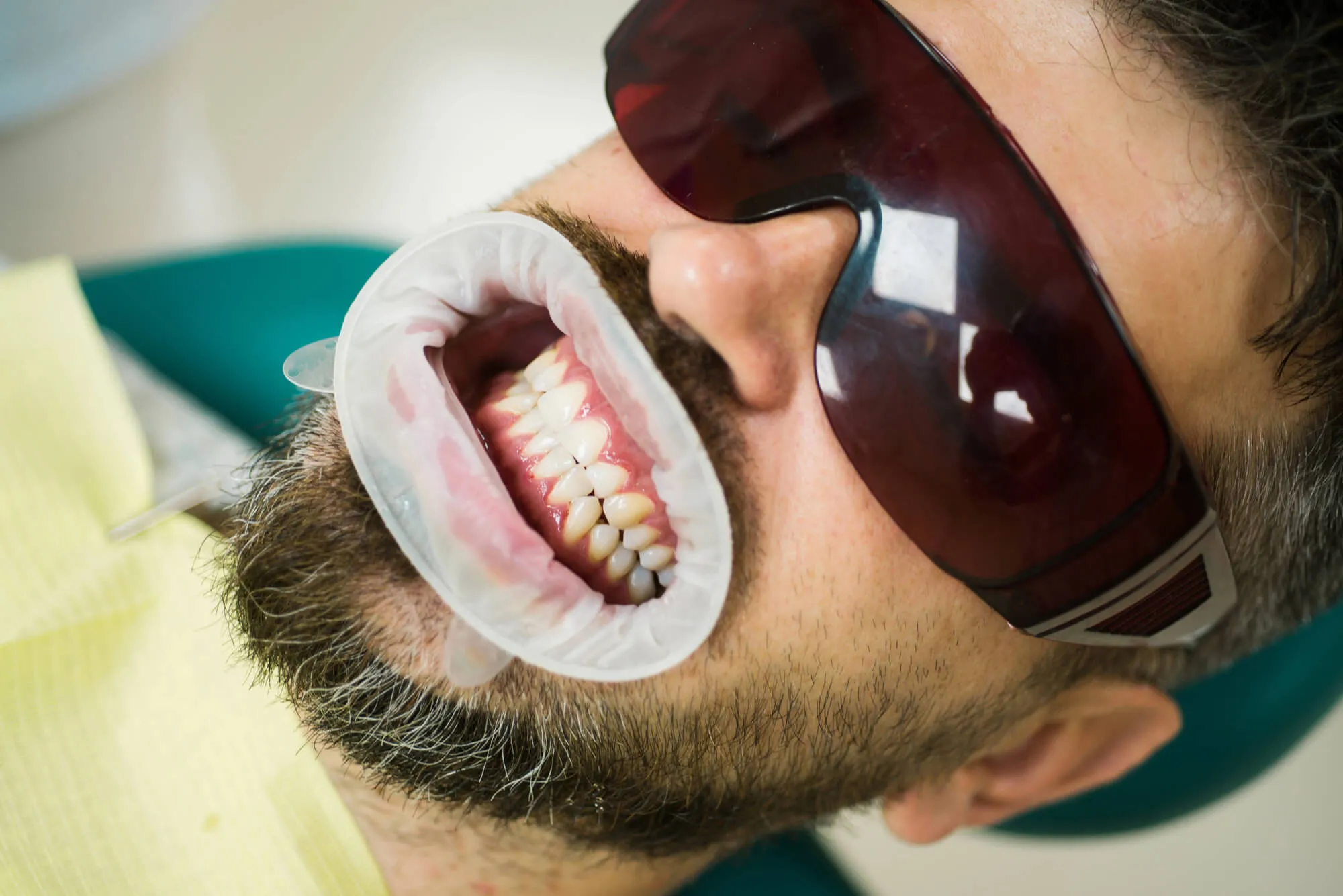 ongoing teeth whitening norristown pa