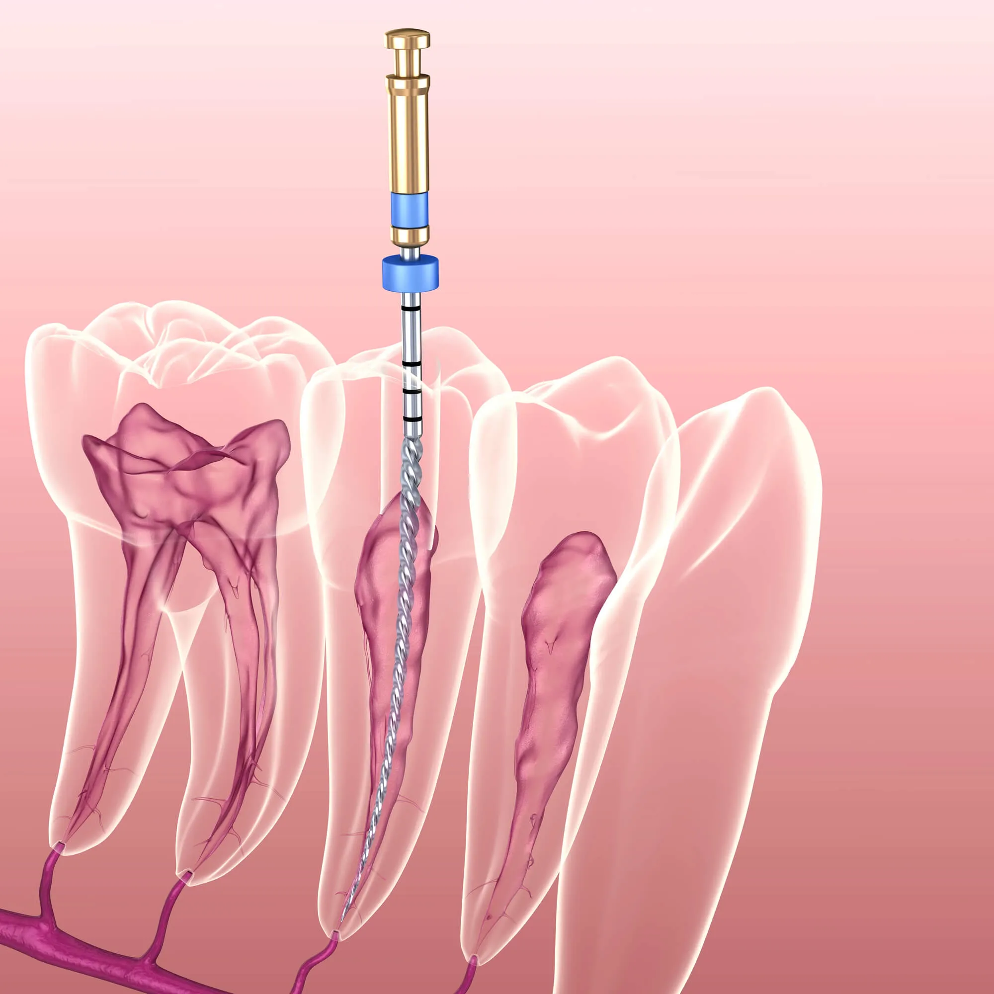 illustration of root canal norristown pa