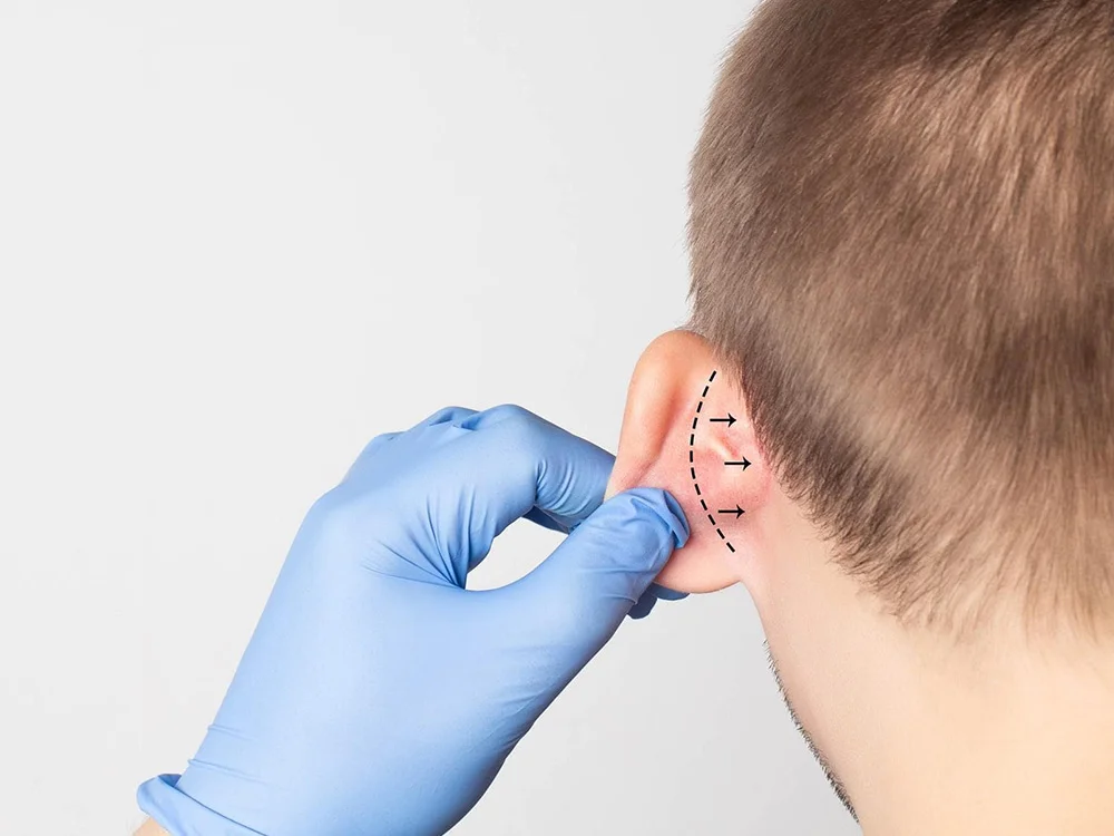 Otoplastia