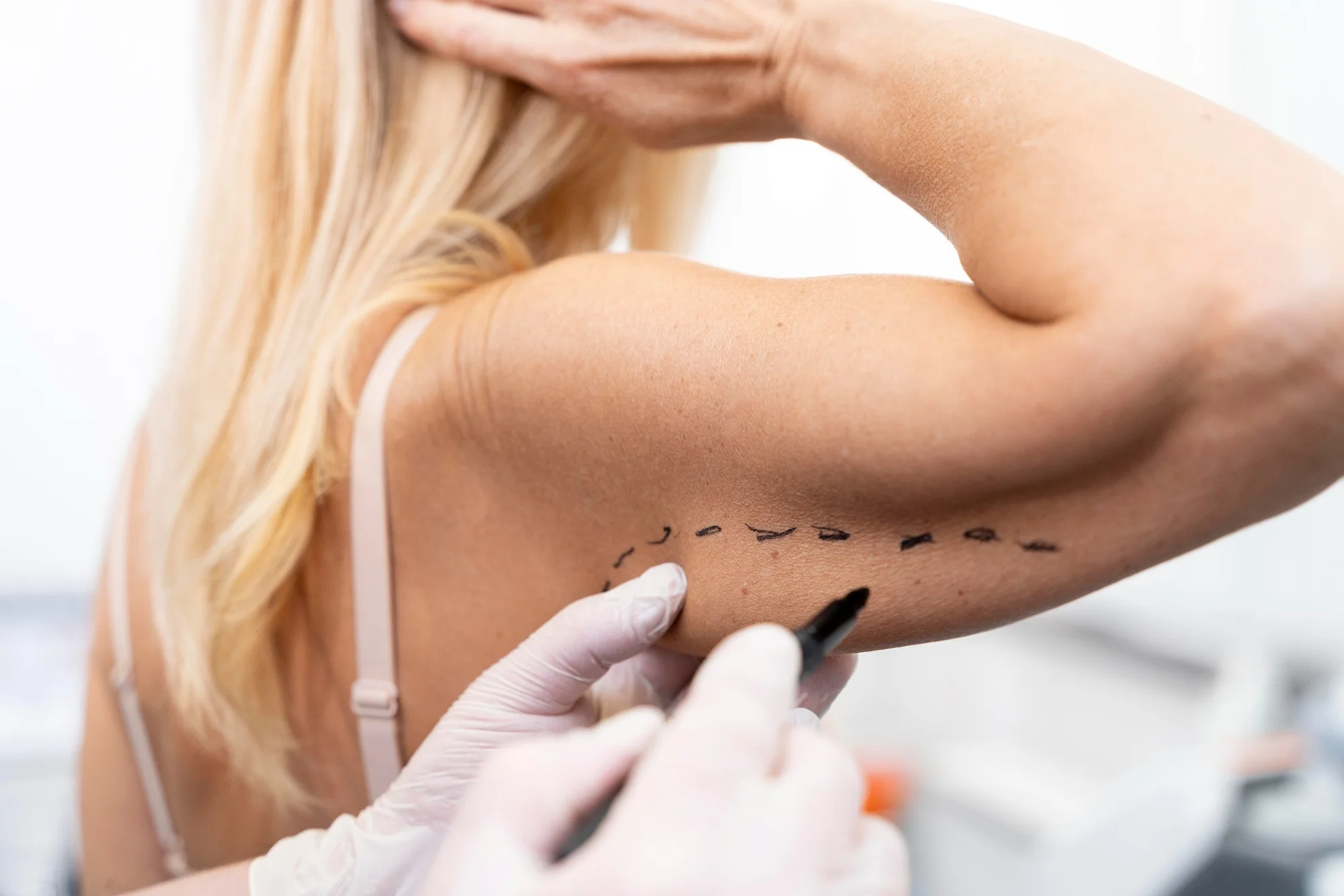 Celulitis y Flacidez