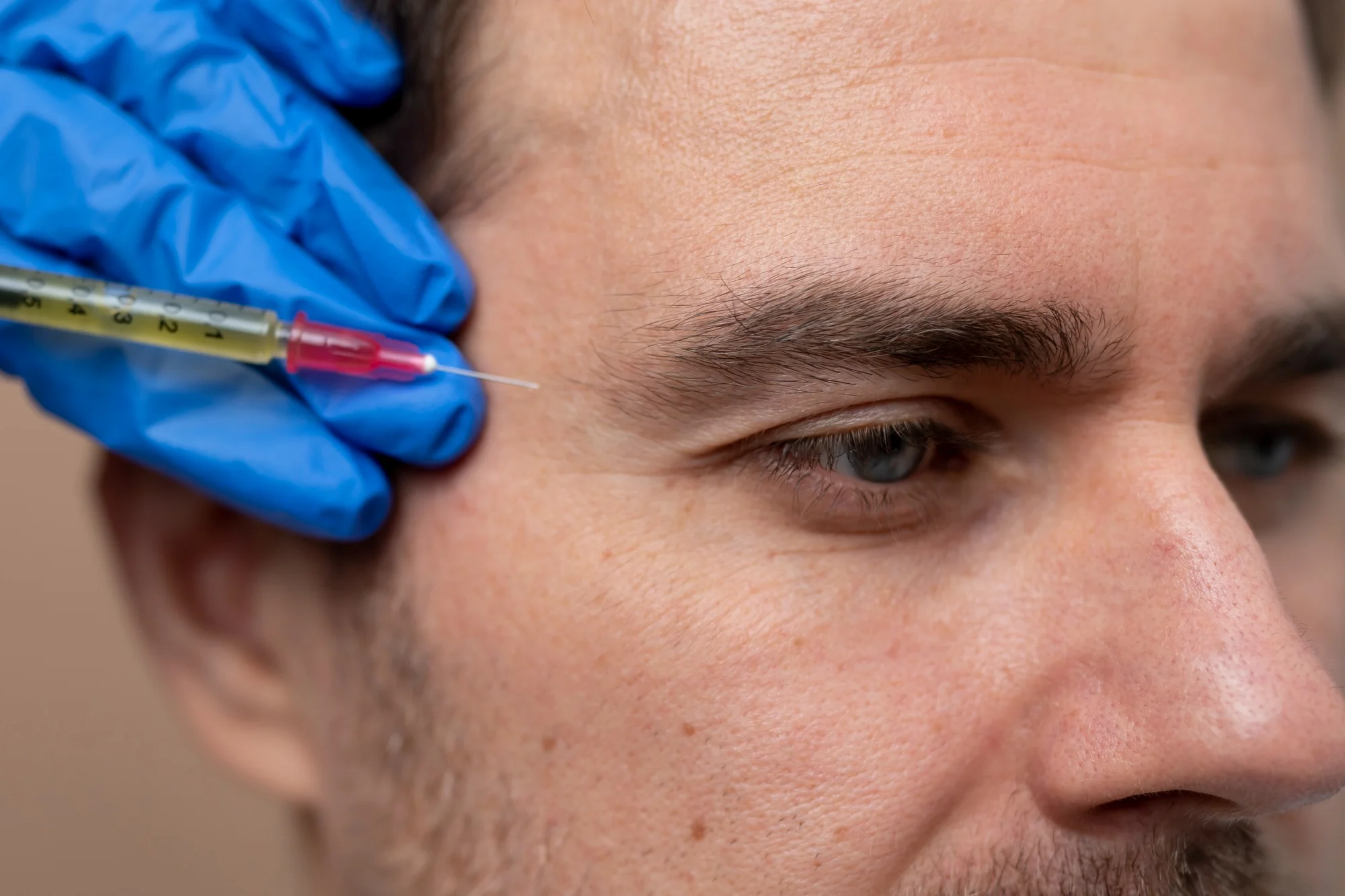 Plasma Rico en Plaquetas (PRP)