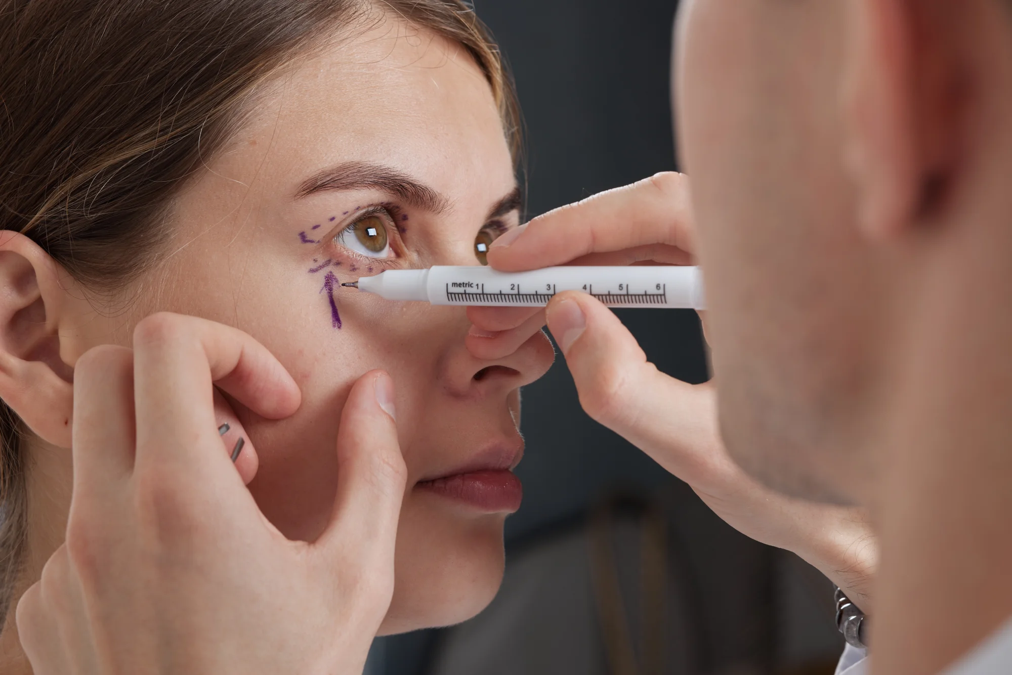Blefaroplastia