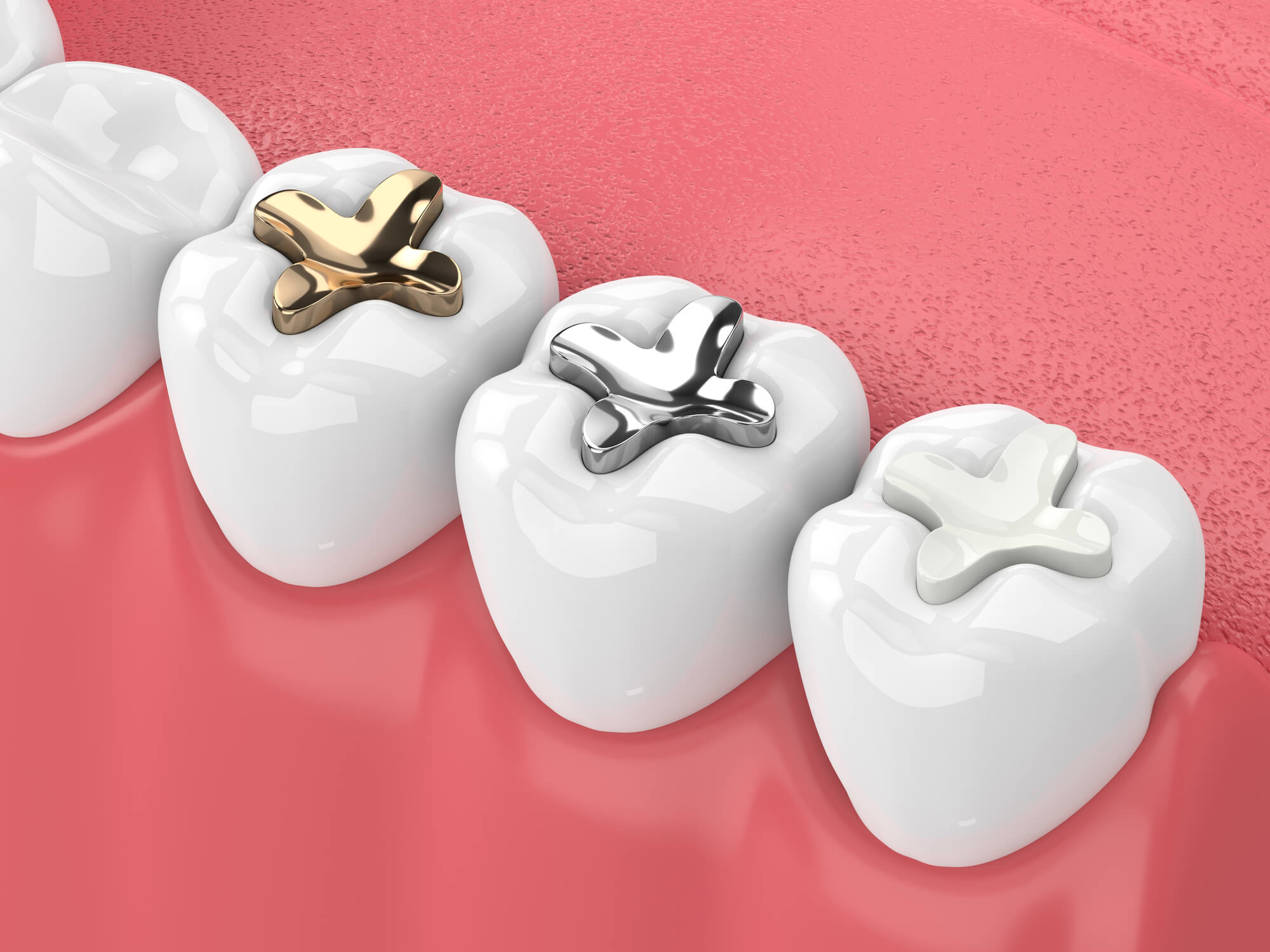 Teeth with metal and porcelain inlays and onlays