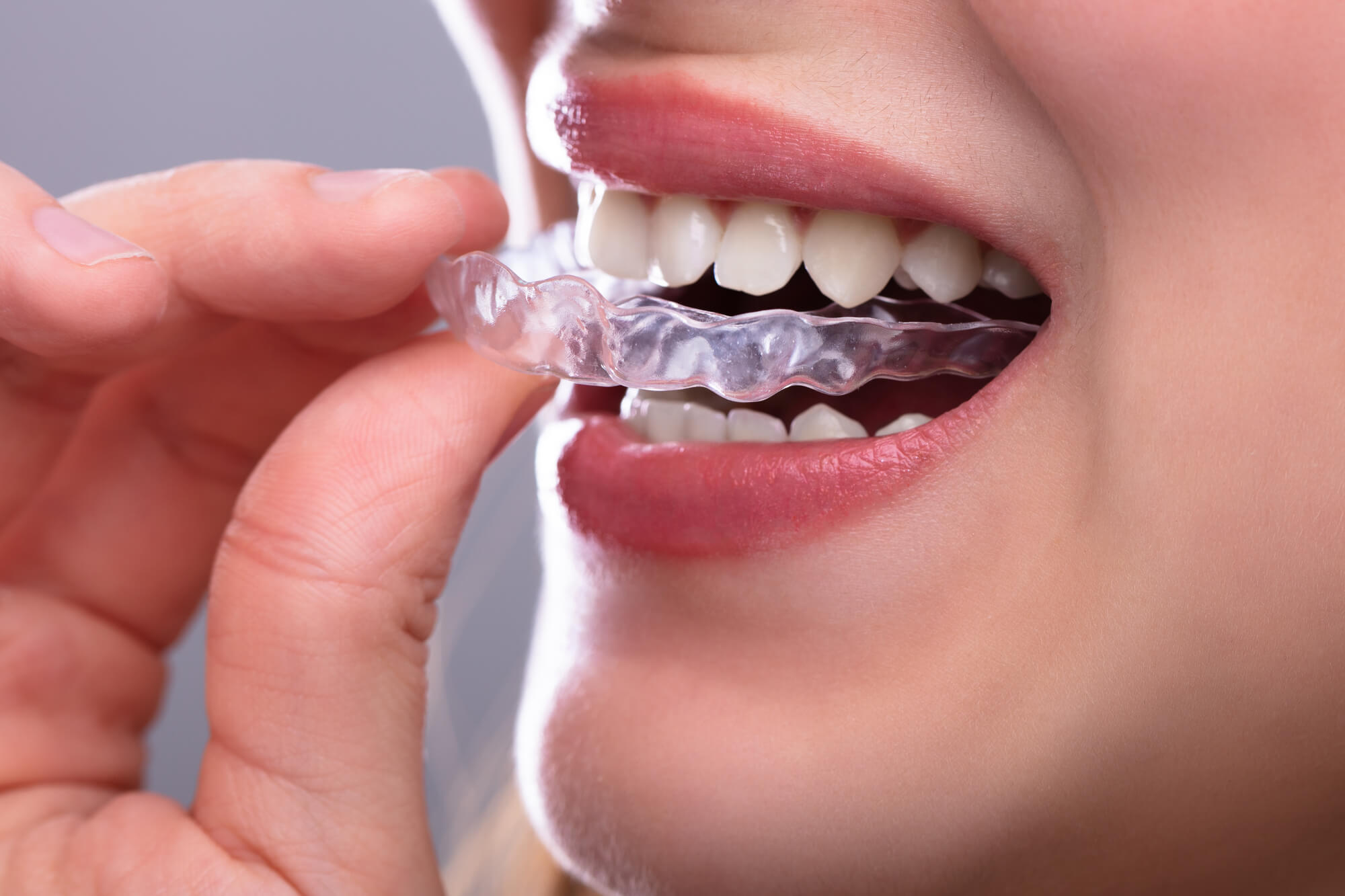 person putting on their clear aligners