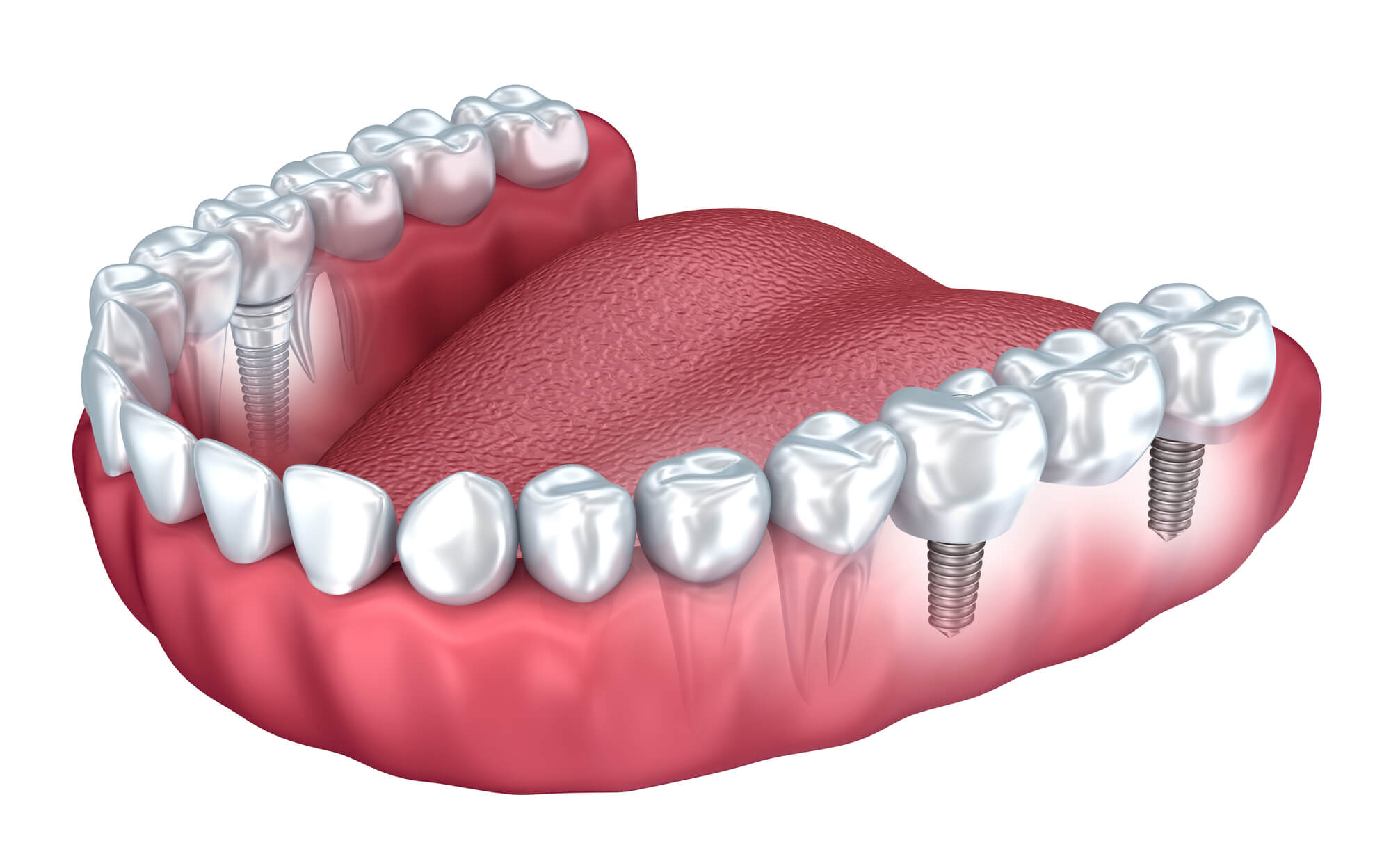 lower teeth with dental implants