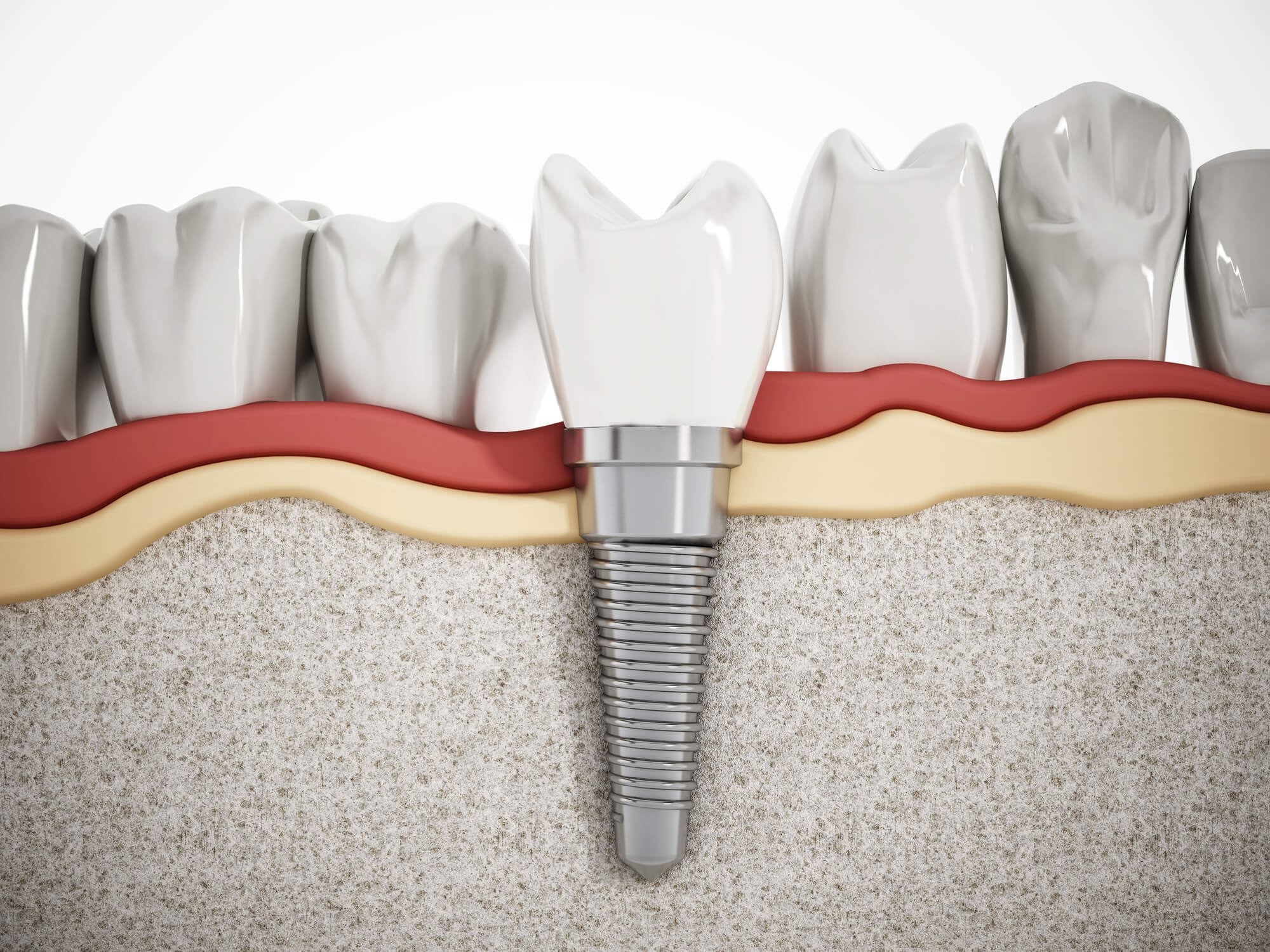 Dental implant placed on the lower jaw