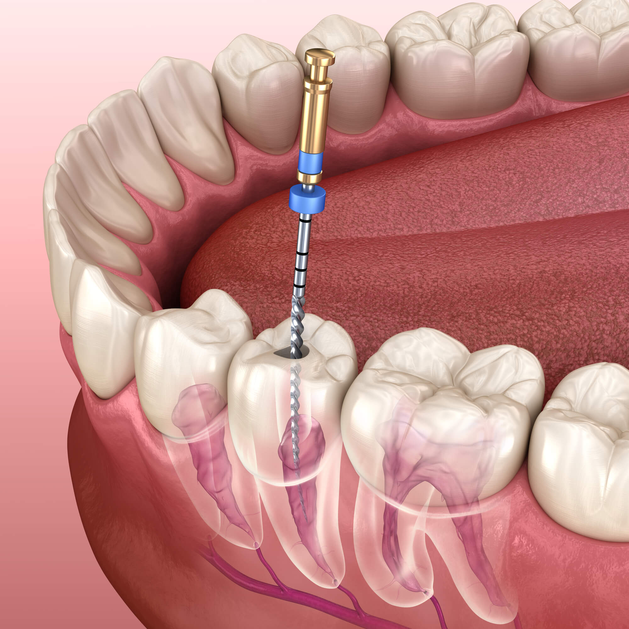 Tooth undergoing a root canal
