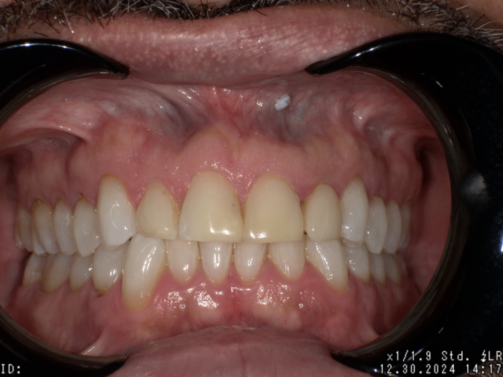 Close-up view of upper and lower teeth with dental retractors holding lips apart, showing slightly discolored front teeth and healthy gums.