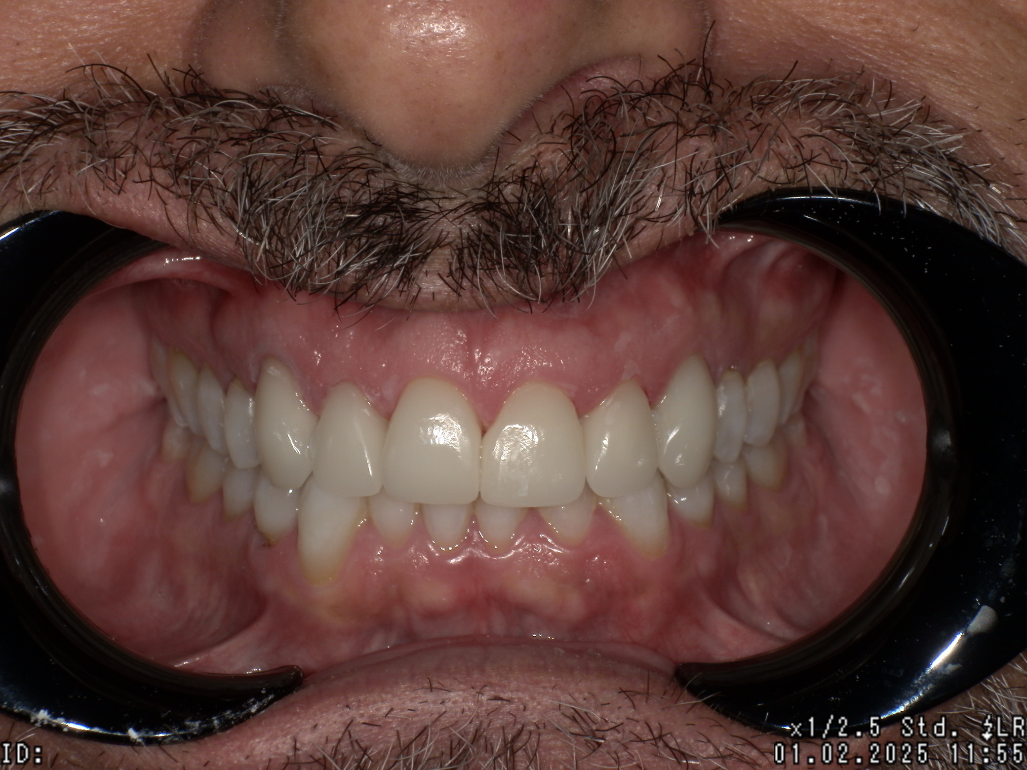 Close-up of a person's mouth showing upper and lower teeth with dental cheek retractors in place.
