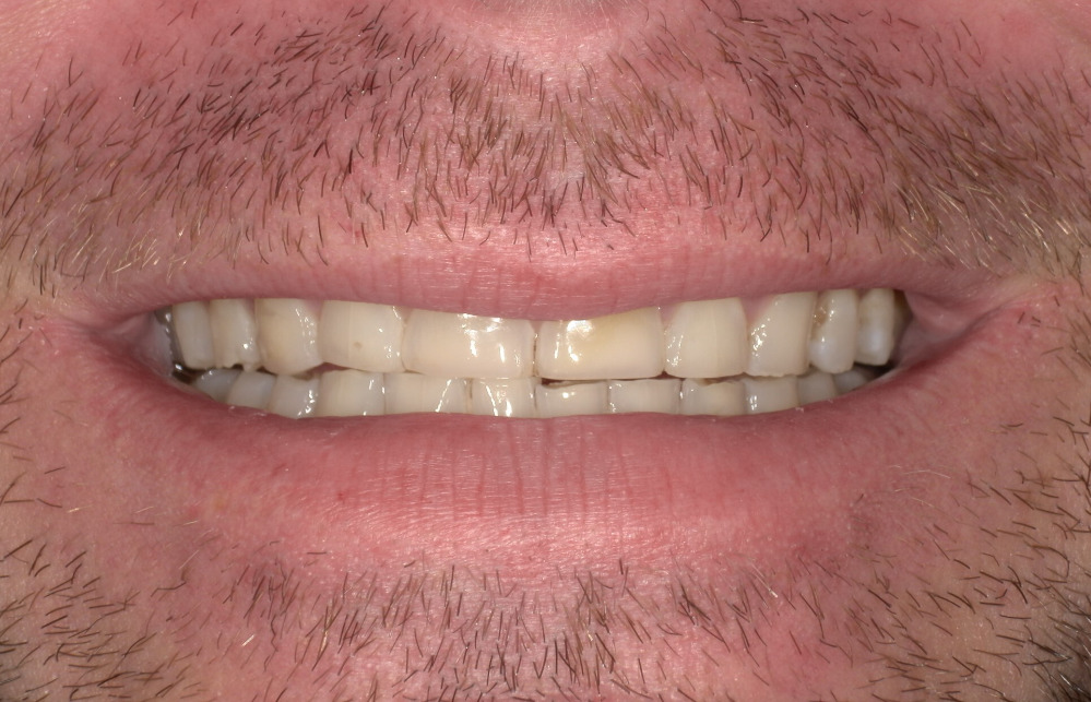 Close-up of a man's mouth showing slightly stained and misaligned upper front teeth with some facial hair around the lips.