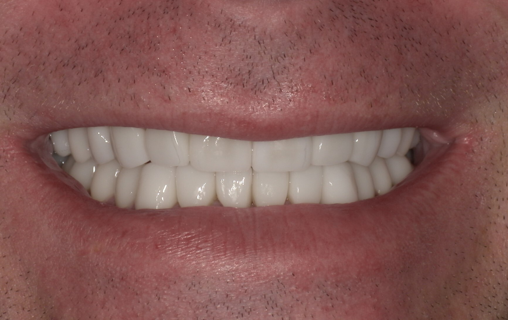 Close-up of a person's mouth showing a bright, even, white smile with well-aligned teeth.