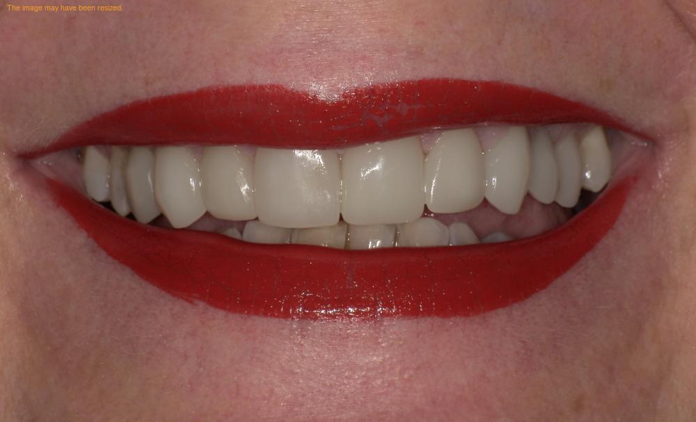 Close-up of a smile with red lipstick and visible upper and lower teeth.