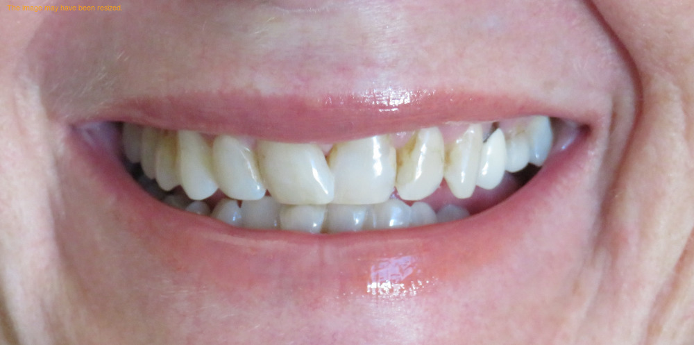 Close-up of a person's smile showing slightly stained upper teeth and clean lower teeth.