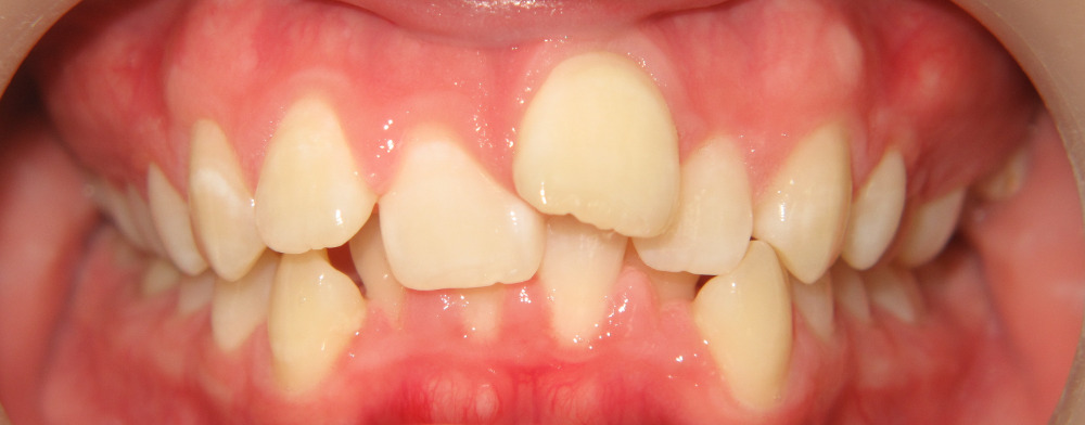 Close-up of a person's mouth showing misaligned and crowded teeth with uneven spacing and irregular tooth size.