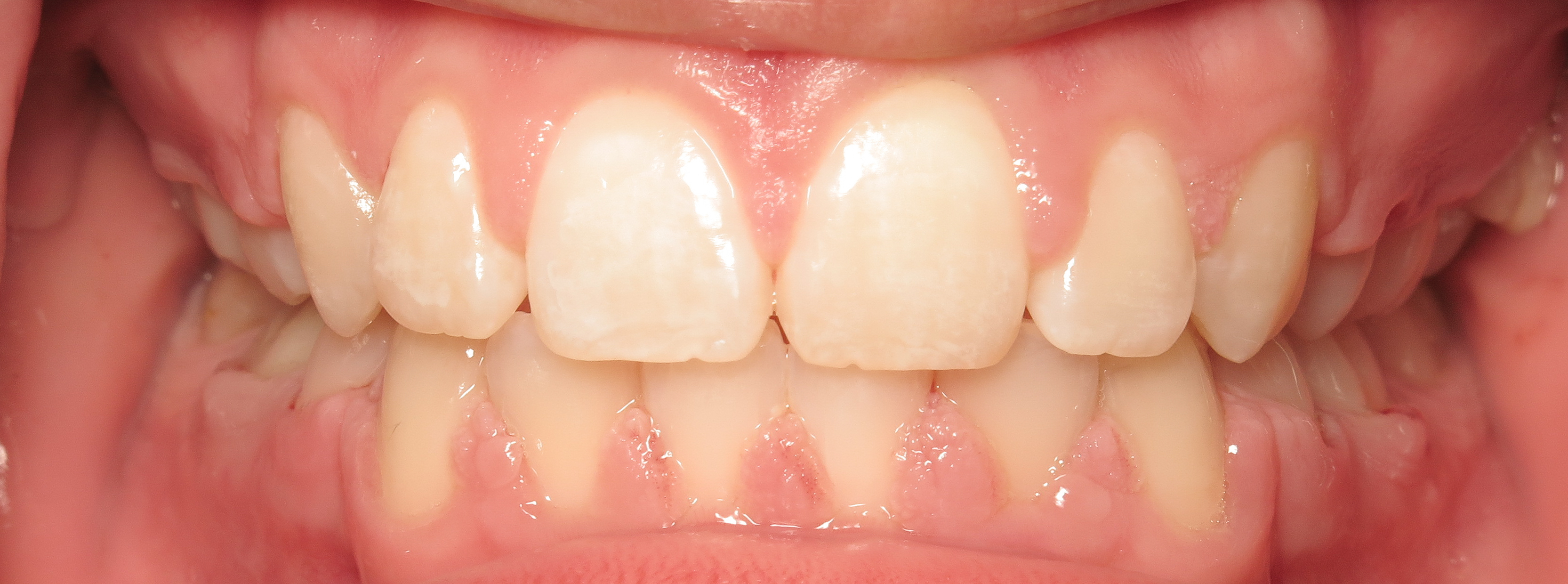 Close-up of a person's upper and lower front teeth with visible gums and slight discoloration on some teeth.