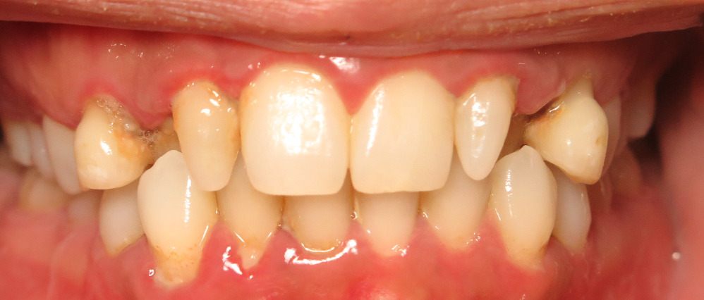Close-up of upper and lower teeth showing severe dental decay and gum inflammation.