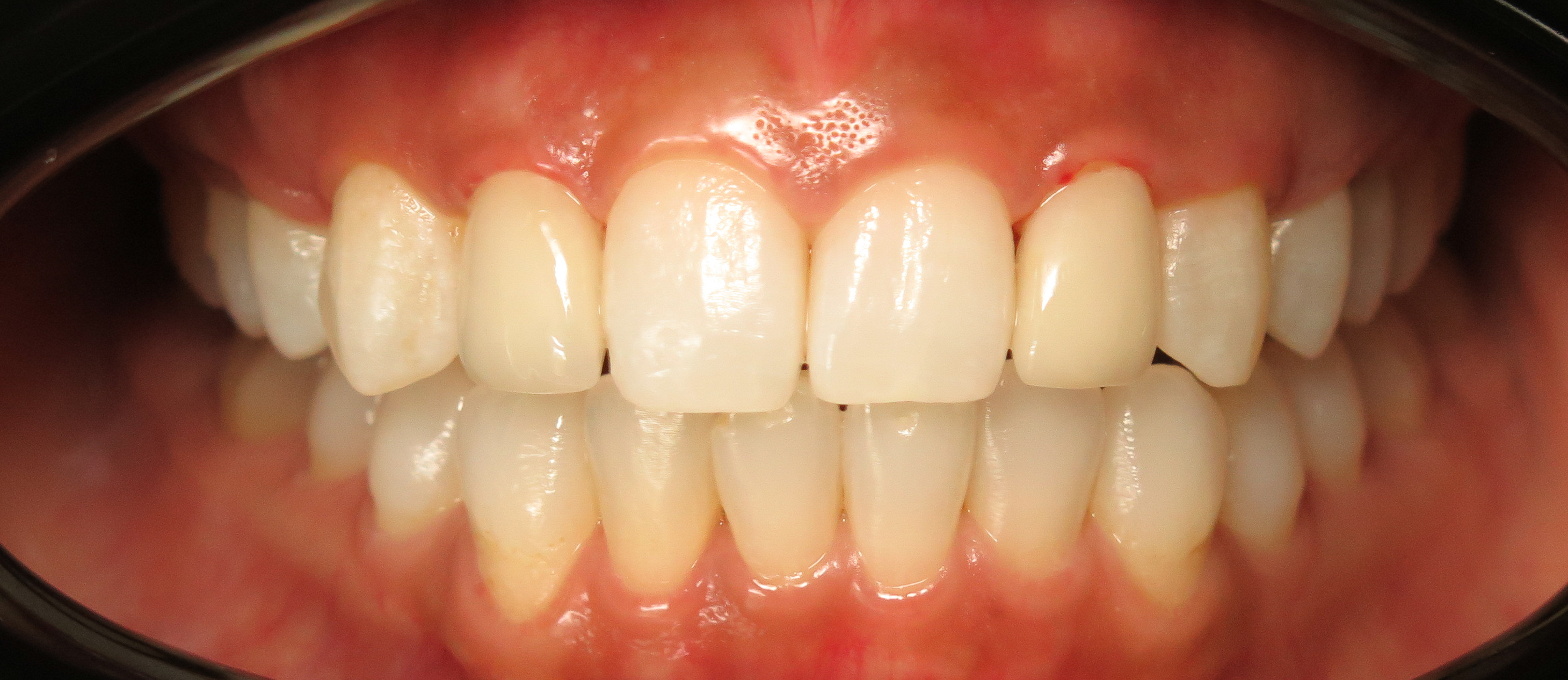 Close-up of upper and lower front teeth with healthy gums and slight plaque buildup on lower teeth.