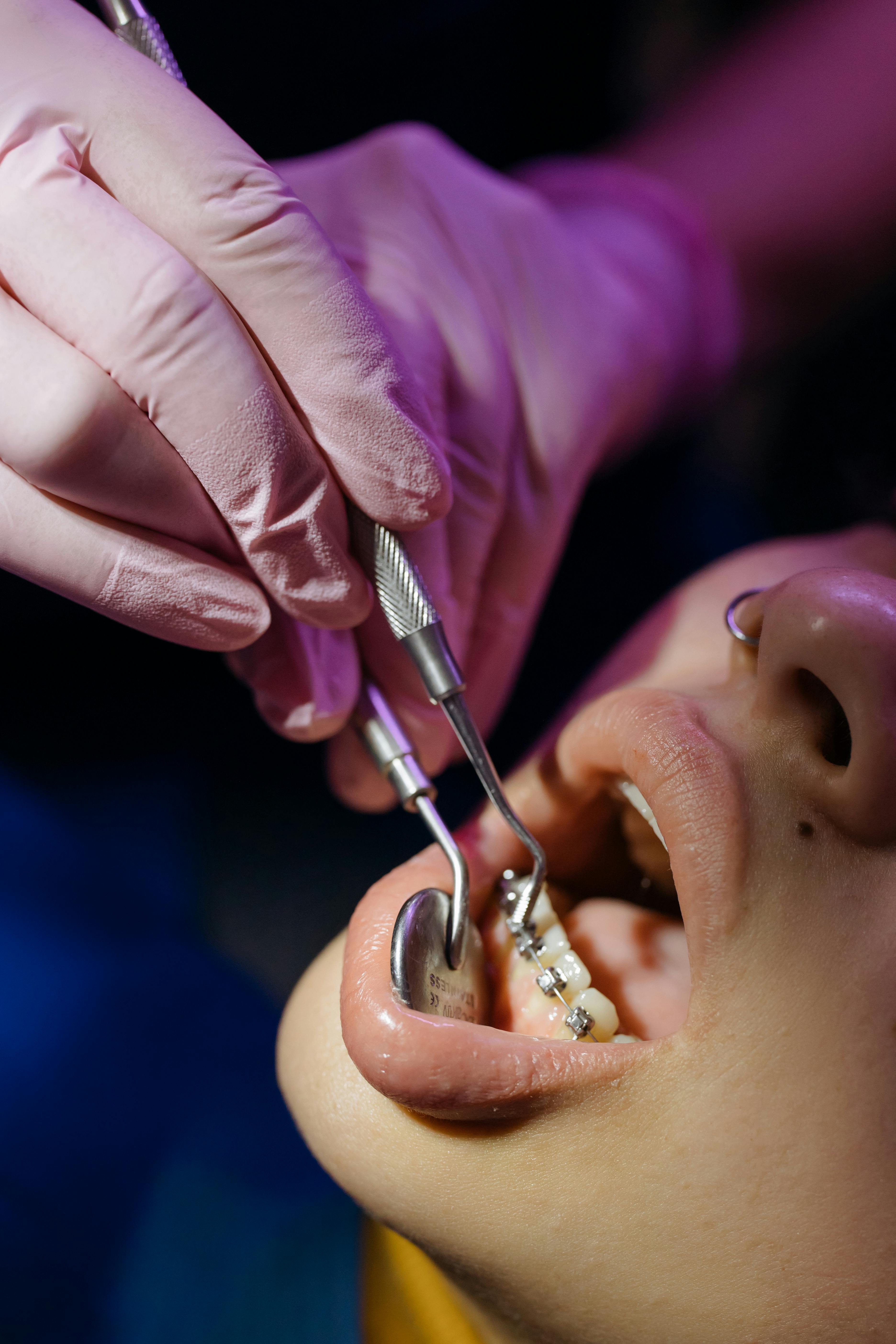 Close-up of a dental checkup showing gloved hands holding tools to inspect teeth with braces.
