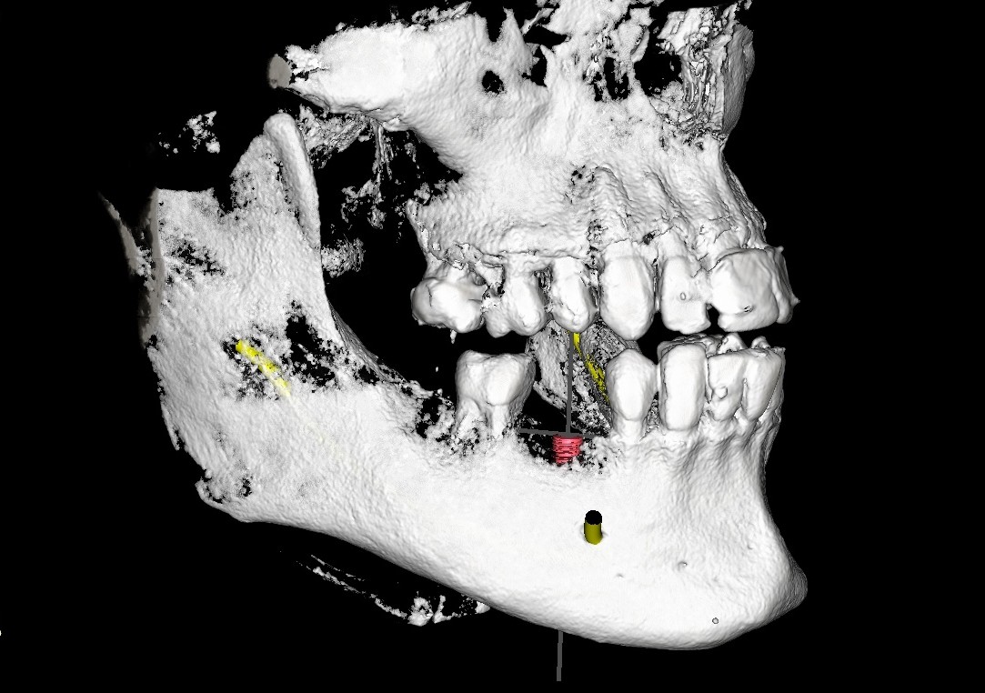 3D medical scan of a human skull focusing on the lower jaw with visible teeth and a dental implant screw in place.
