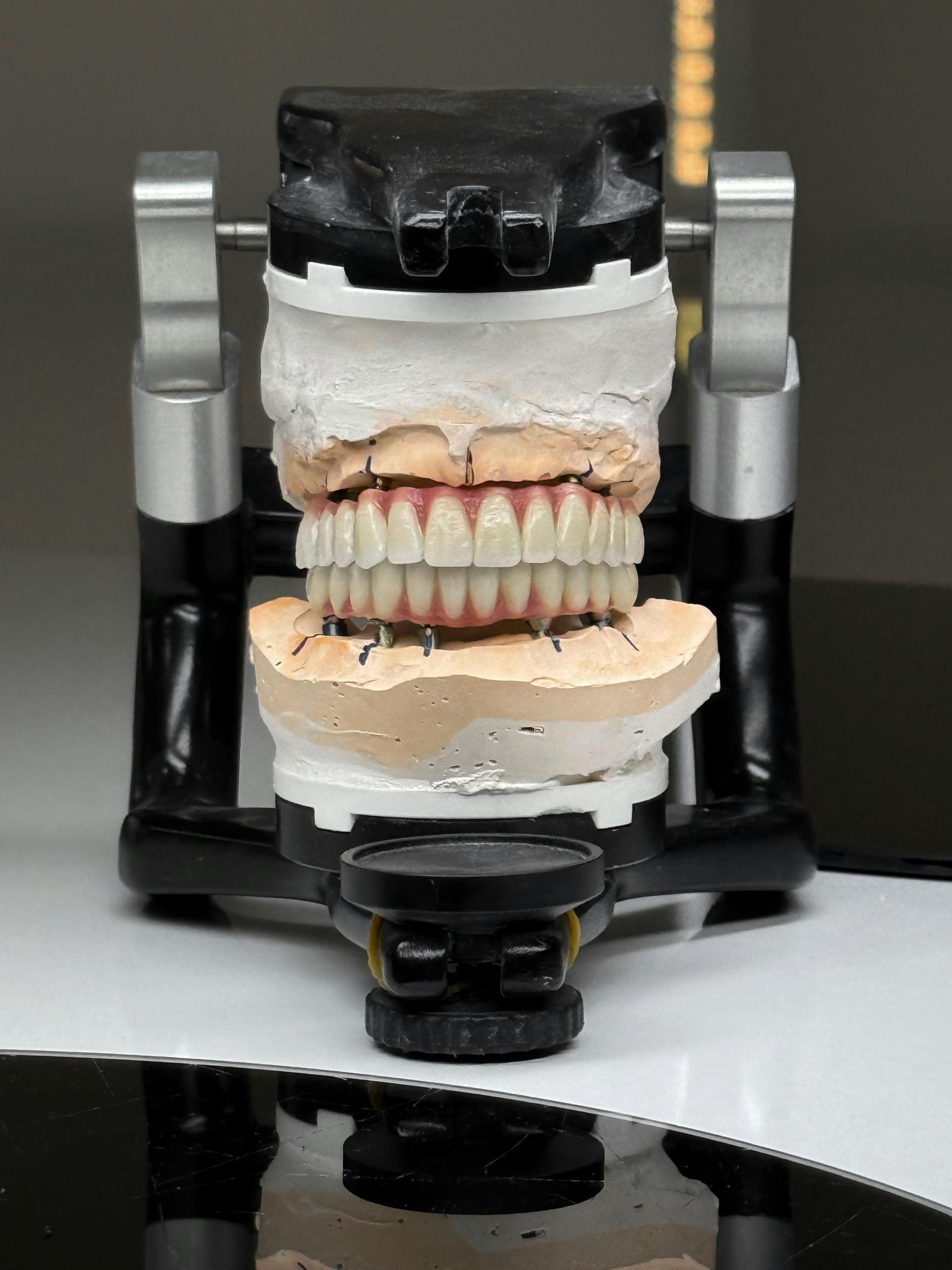 Dental model with artificial teeth mounted on a black articulator device.