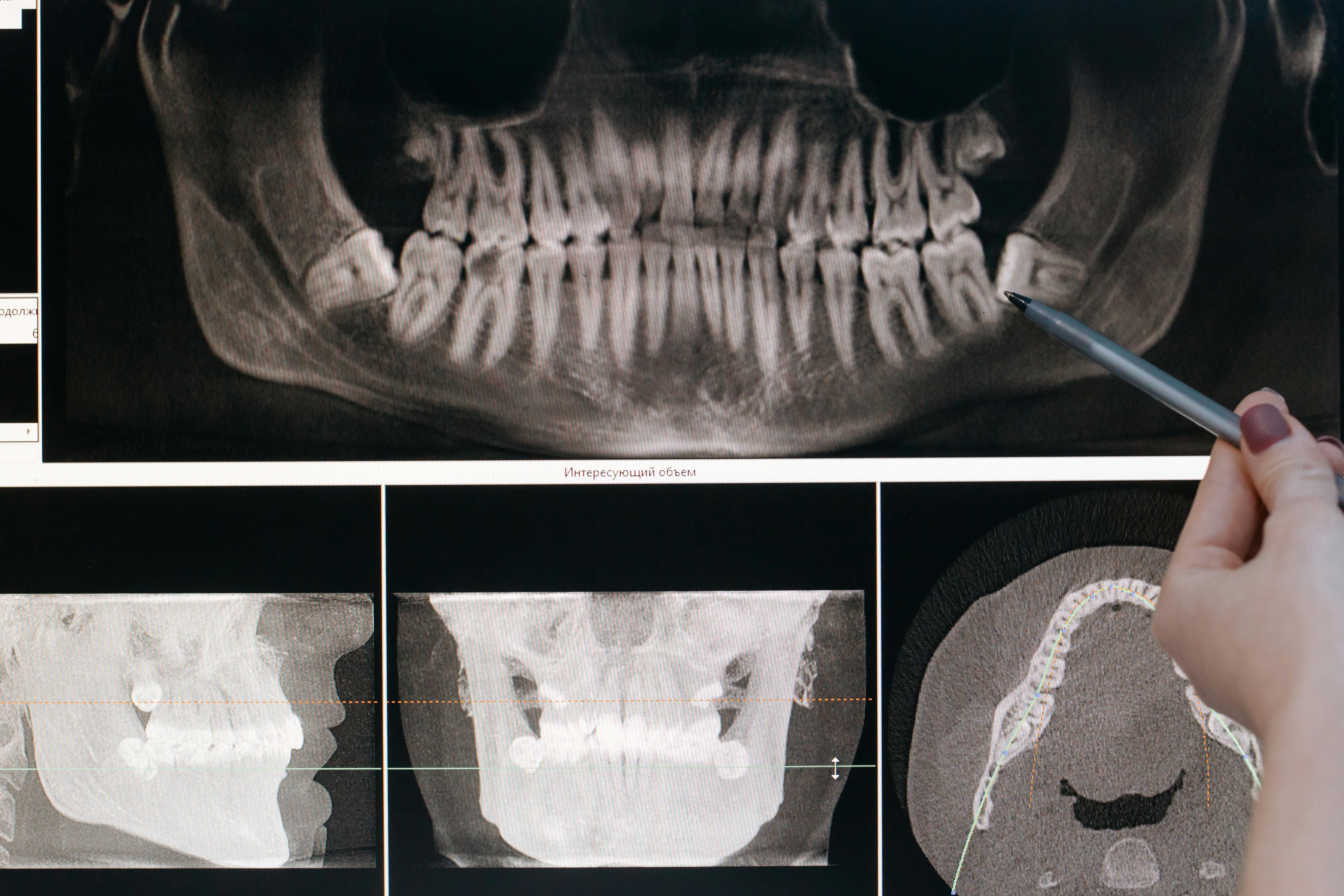 Hand with pen pointing at a dental X-ray showing full set of teeth and jawbone images on a screen.