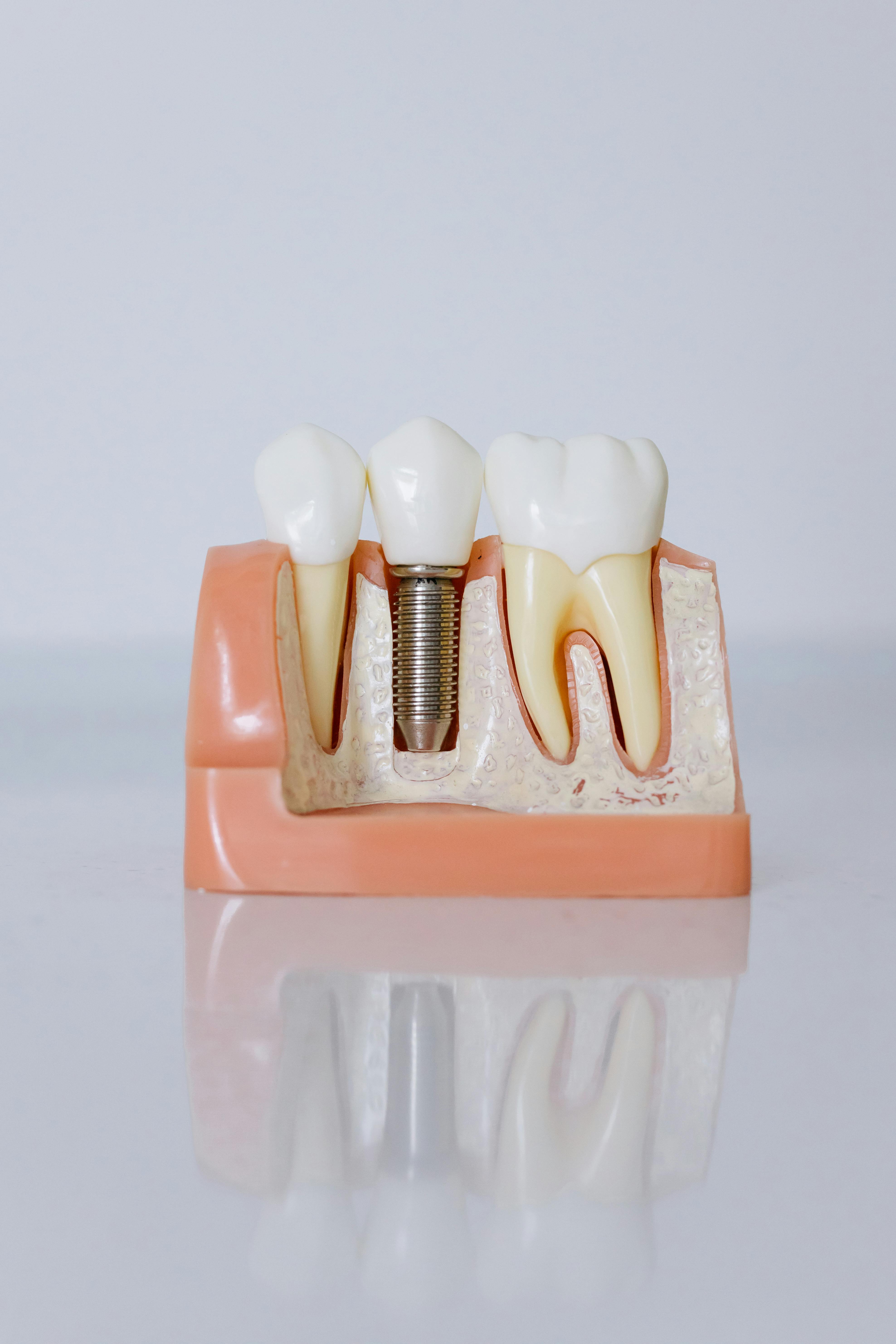 Dental model showing natural teeth alongside a tooth with a metal dental implant in the jawbone.