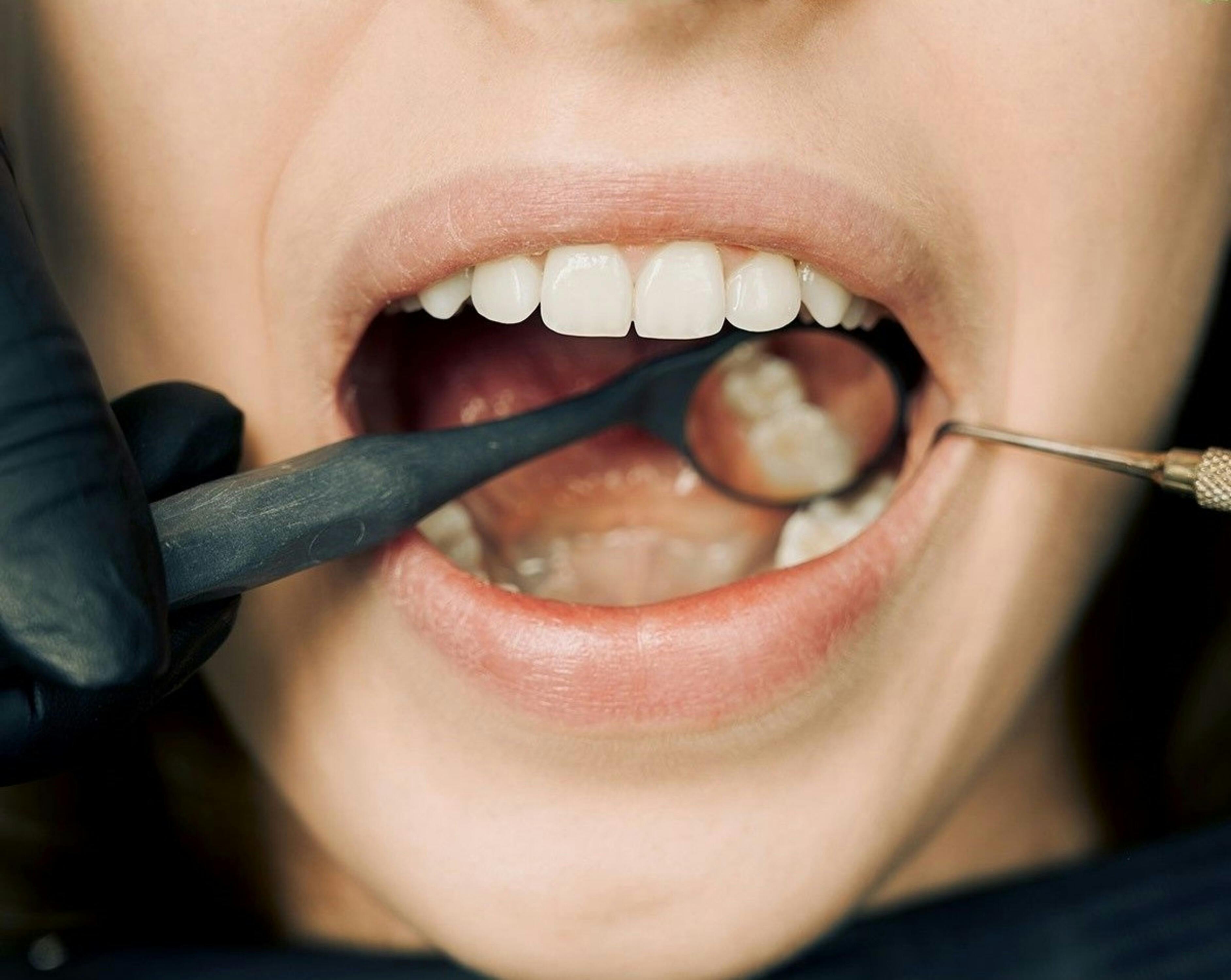 Close-up of a person’s open mouth being examined with a dental mirror and tool by someone wearing black gloves.