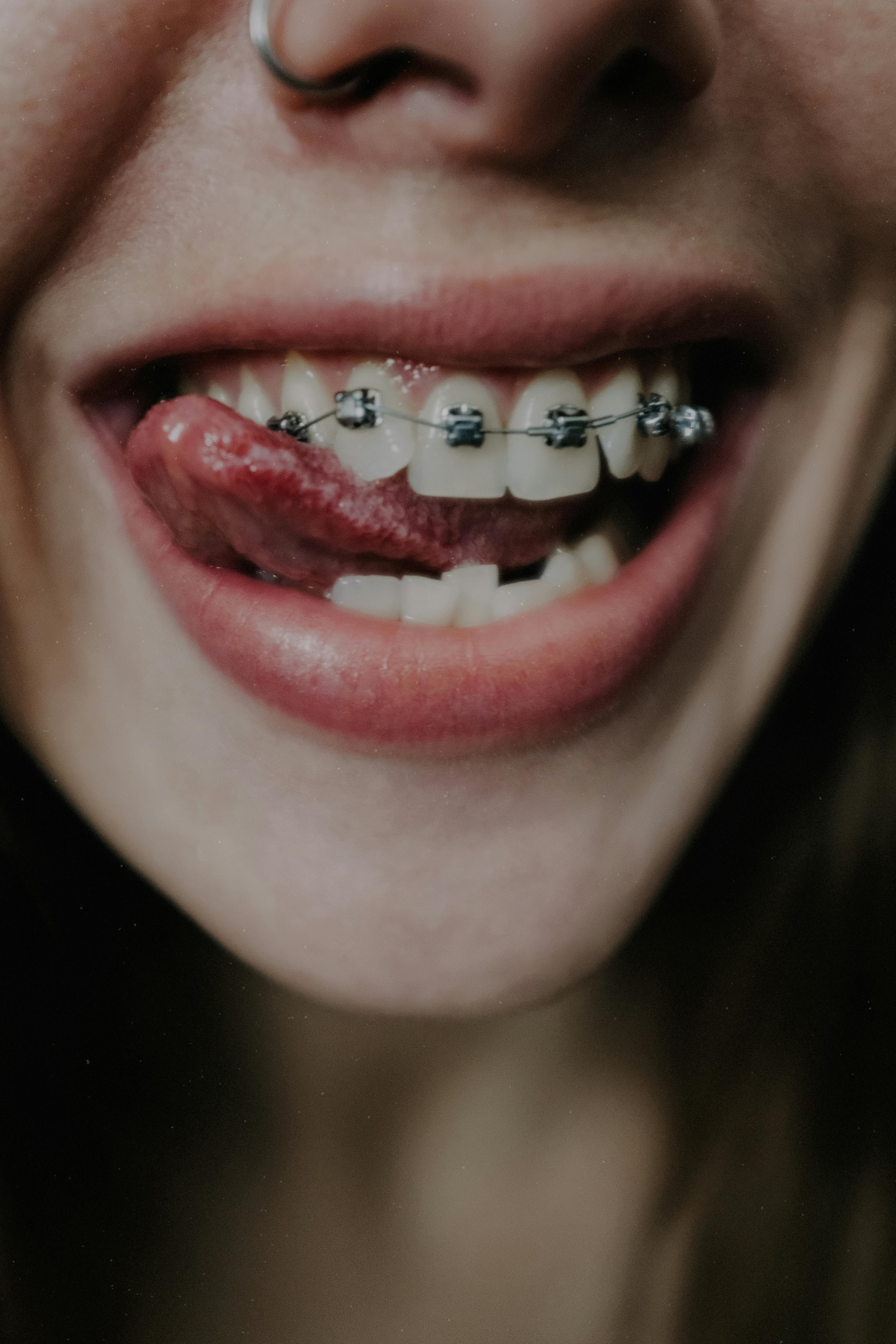 Close-up of a smiling person with braces licking their upper teeth.