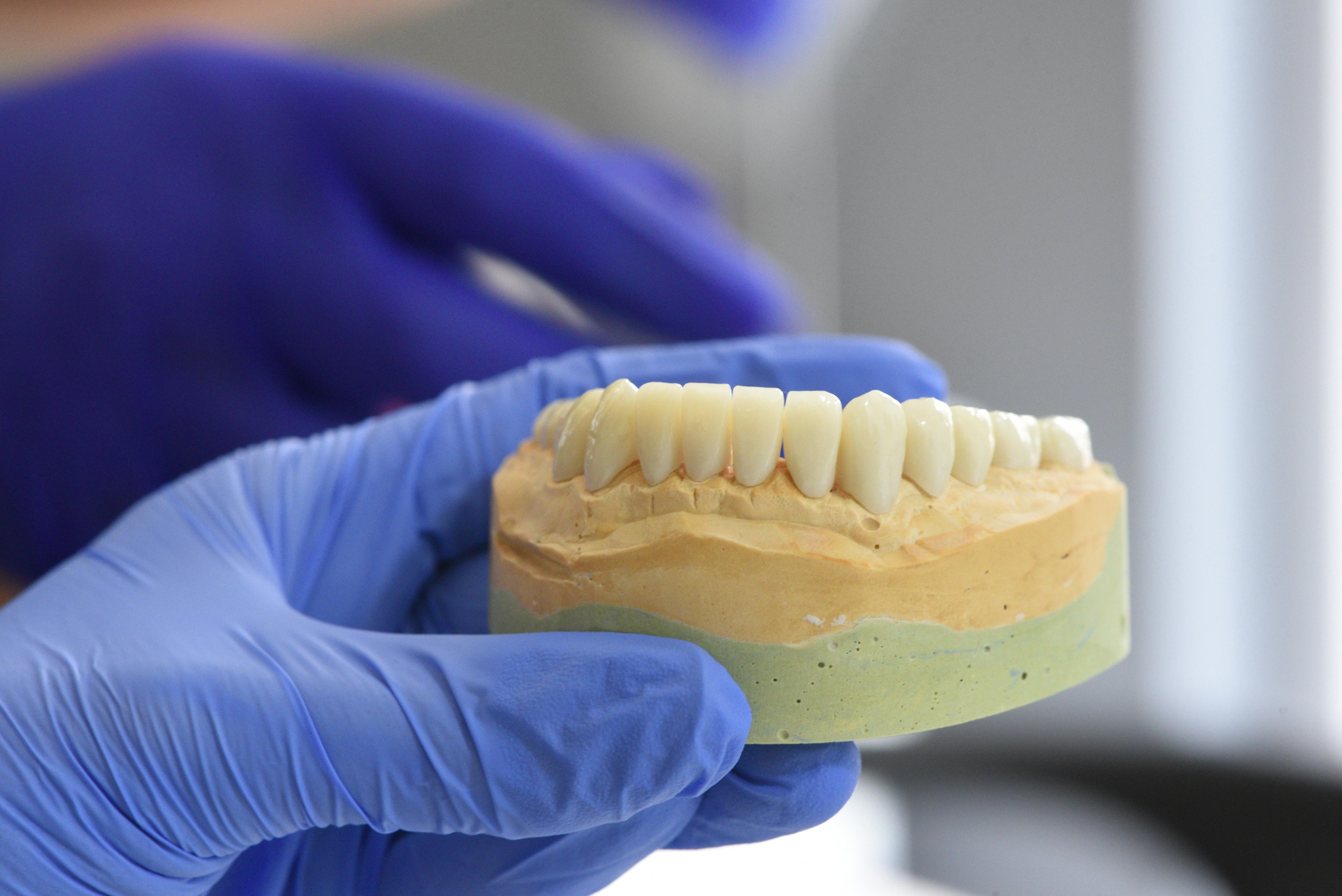Gloved hands holding a dental model with artificial teeth on a plaster base.