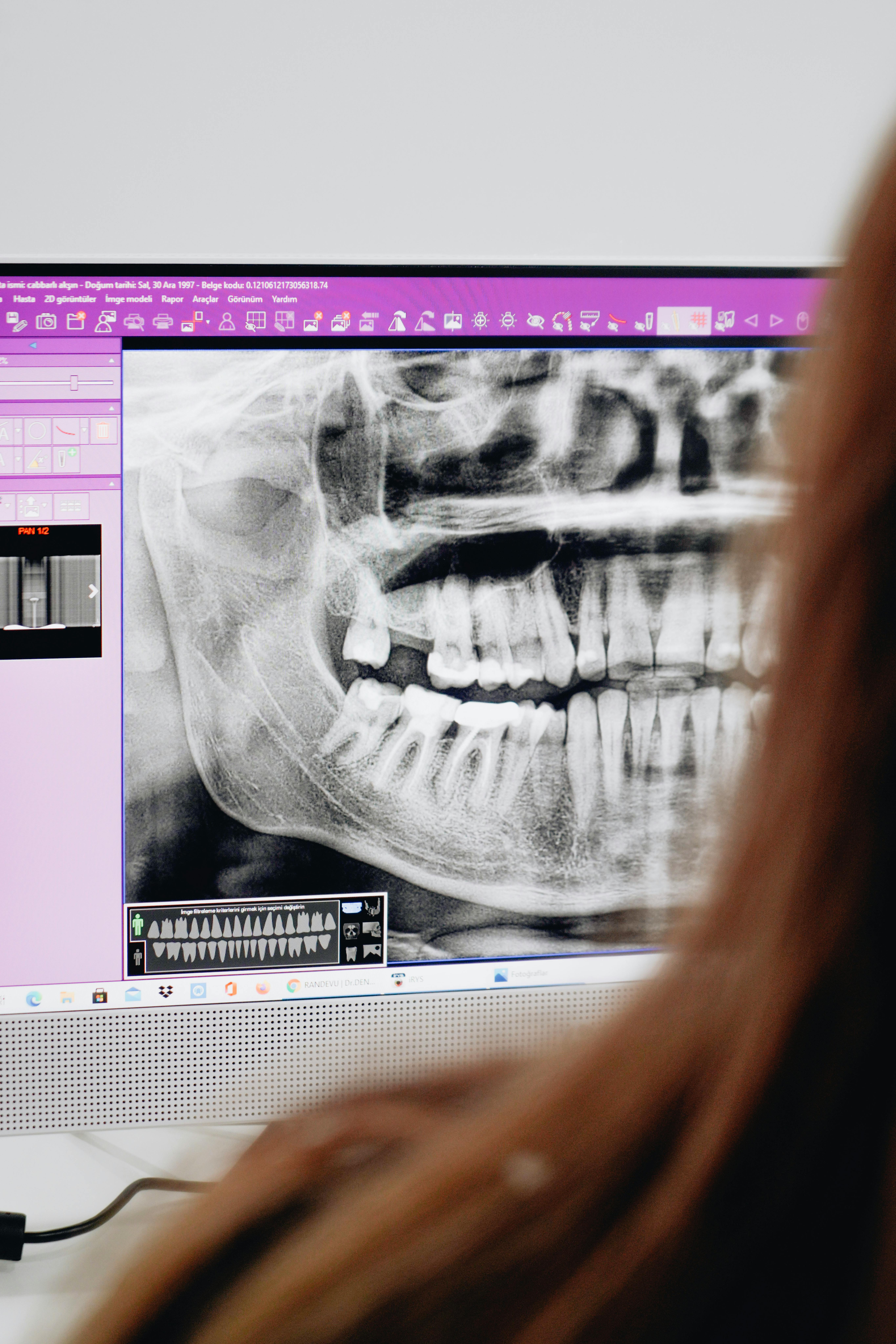 Computer screen displaying a detailed dental X-ray image of a person's teeth and jaw.