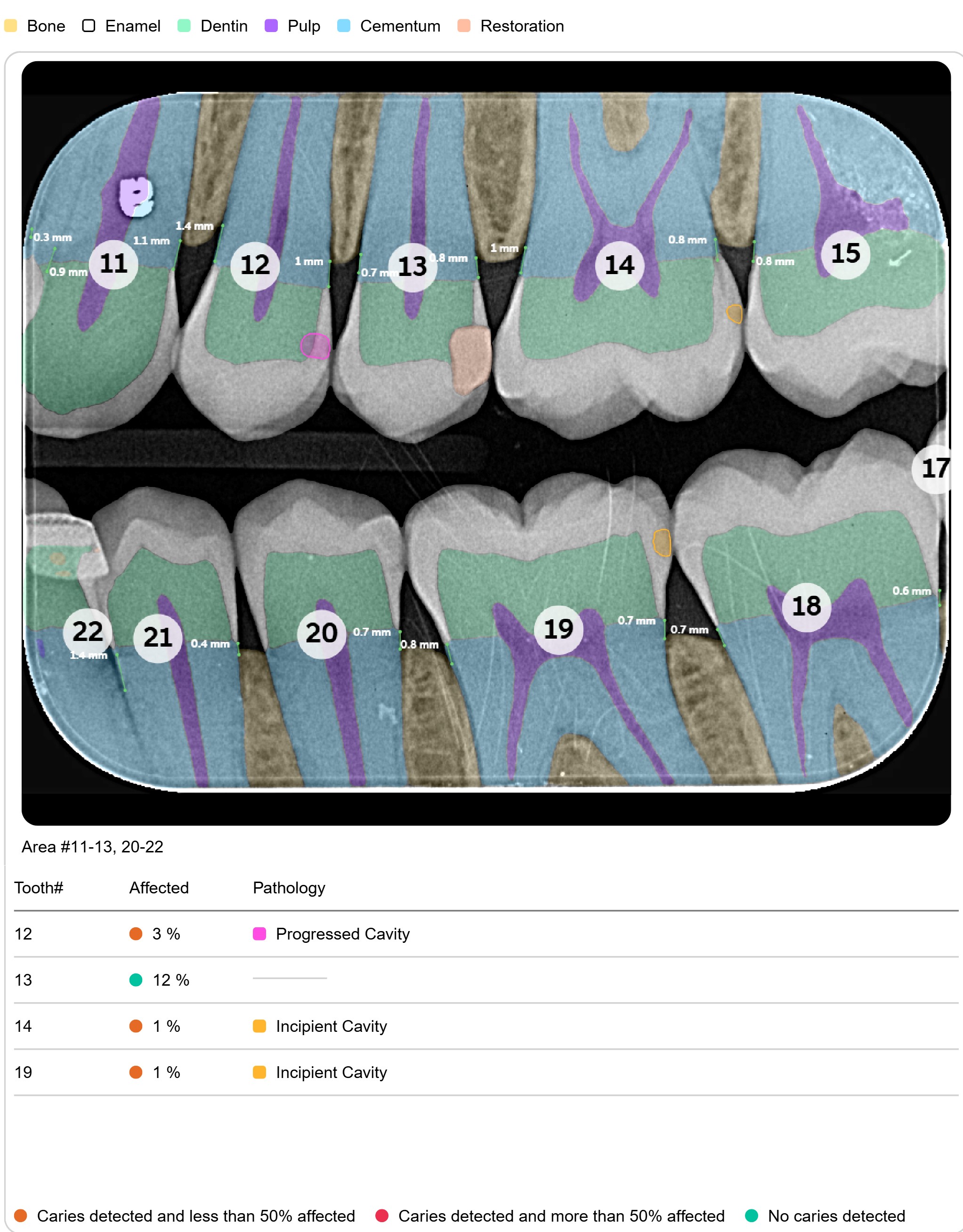 Dental X-ray showing teeth numbered 11 to 22, with color-coded overlays indicating bone in yellow, enamel in white, dentin in green, pulp in purple, cementum in blue, and restorations in pink and orange; annotations highlight caries detection percentages and cavity types on teeth 12, 13, 14, and 19.