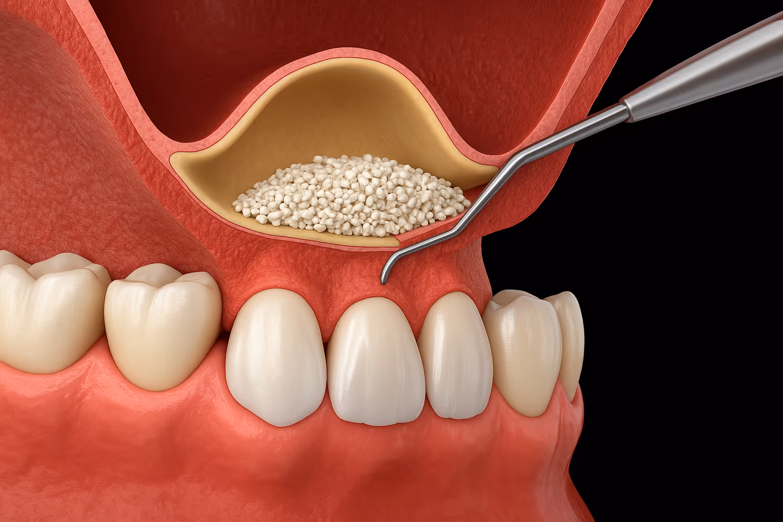 Bone Grafting & Sinus Lift procedure performed at Lakeview Dental.