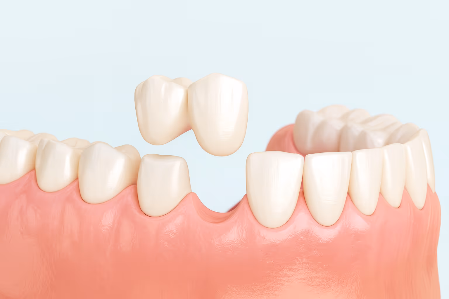Cantilever Bridges procedure performed at Lakeview Dental.