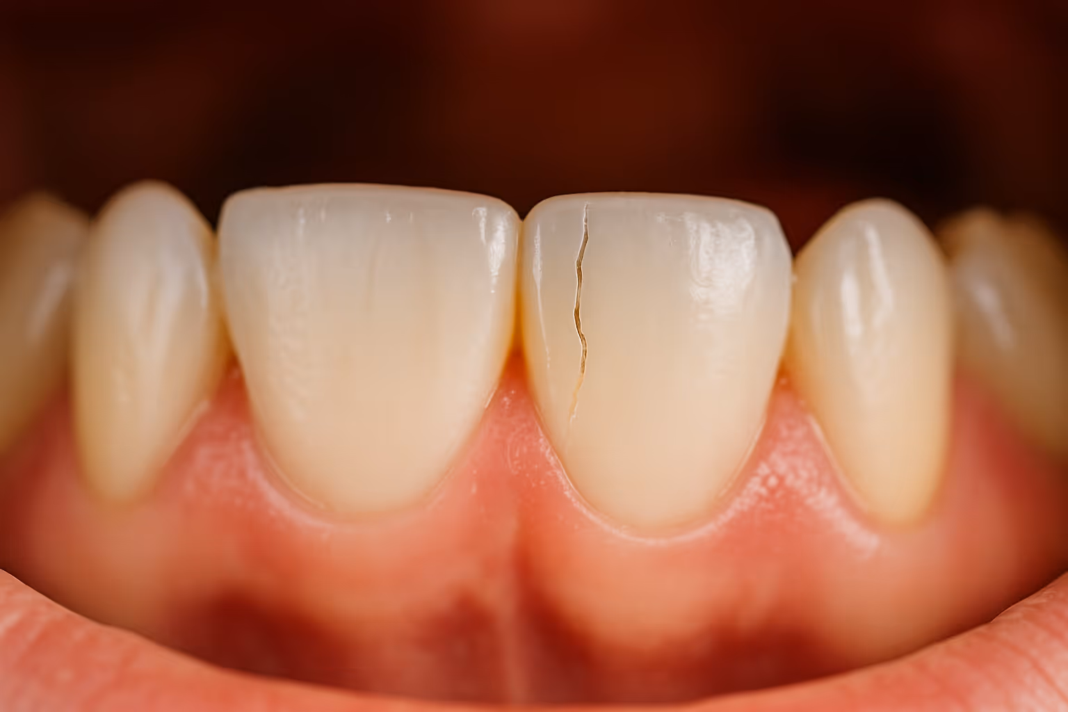 Dental Trauma Management at Lakeview Dental