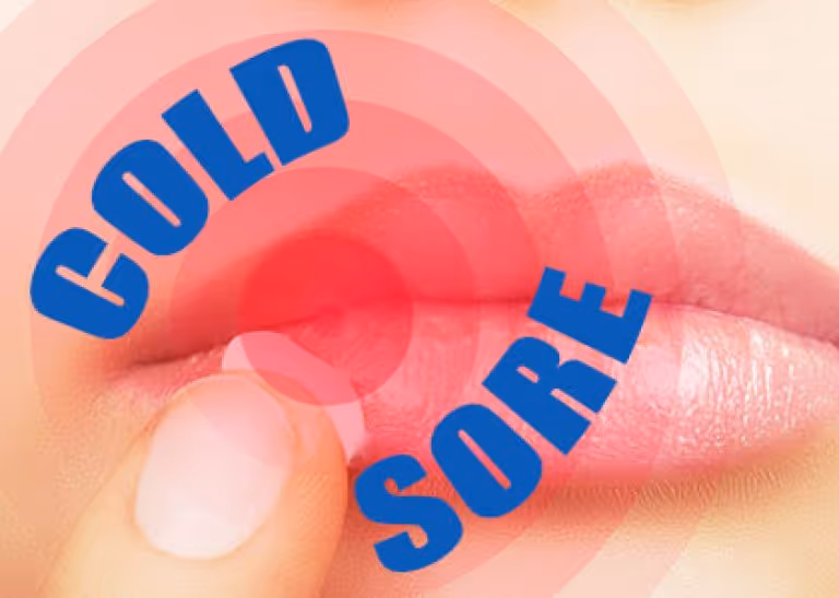 Do I Have Herpes? Cold Sores 101