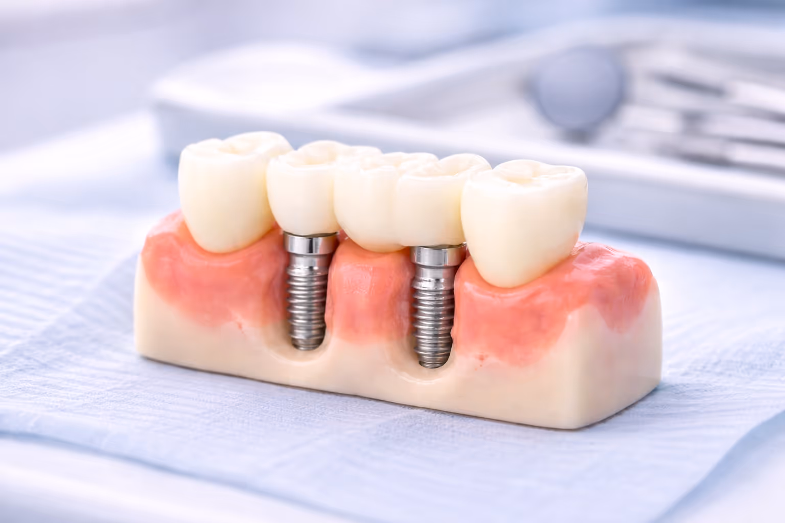 Implant Supported Bridges at Lakevie Dental