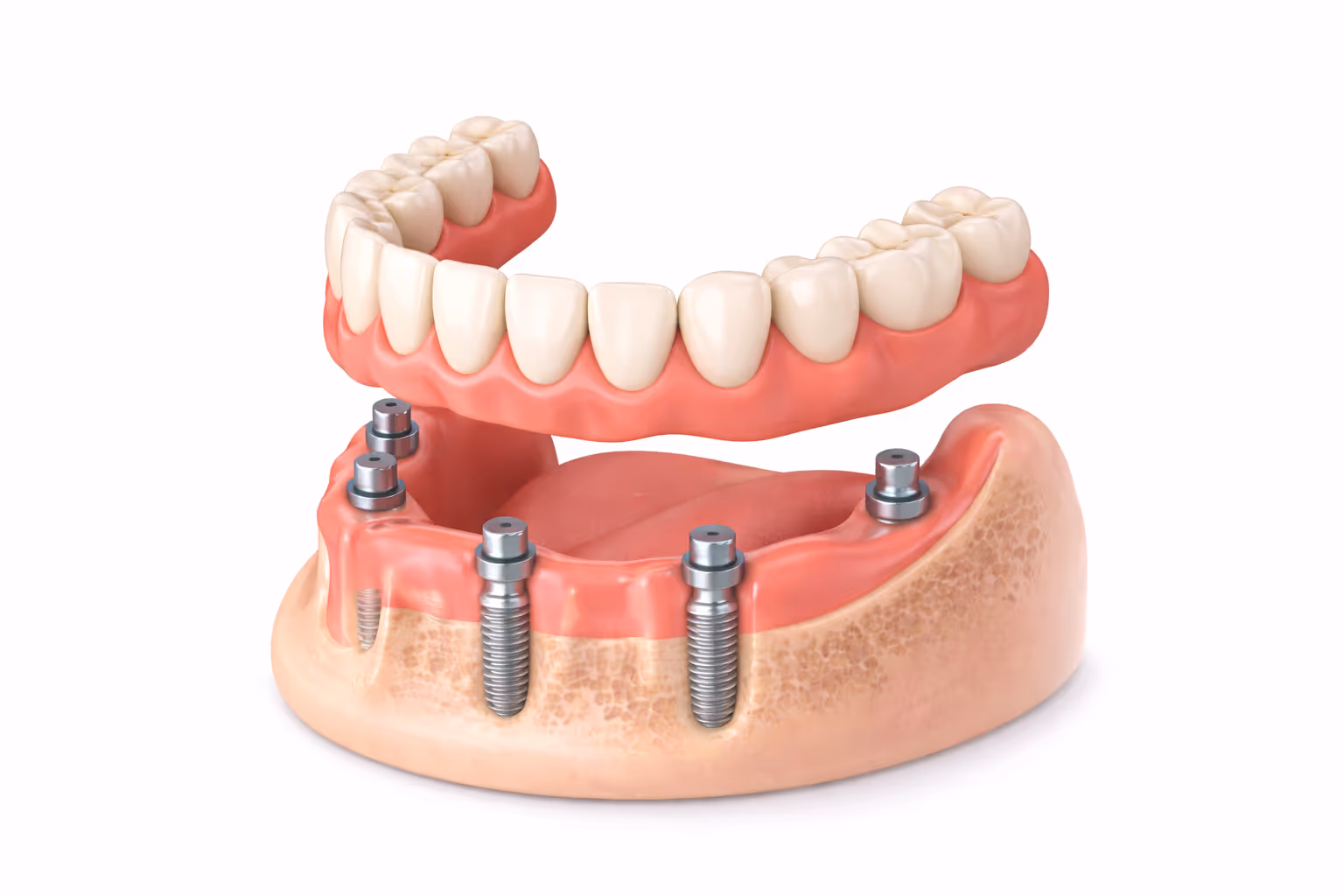 Snap-In Dentures or Fixed Full-Arch Teeth at Lakevie Dental