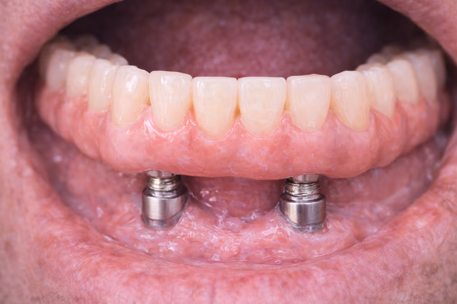 Overdentures at Lakevie Dental