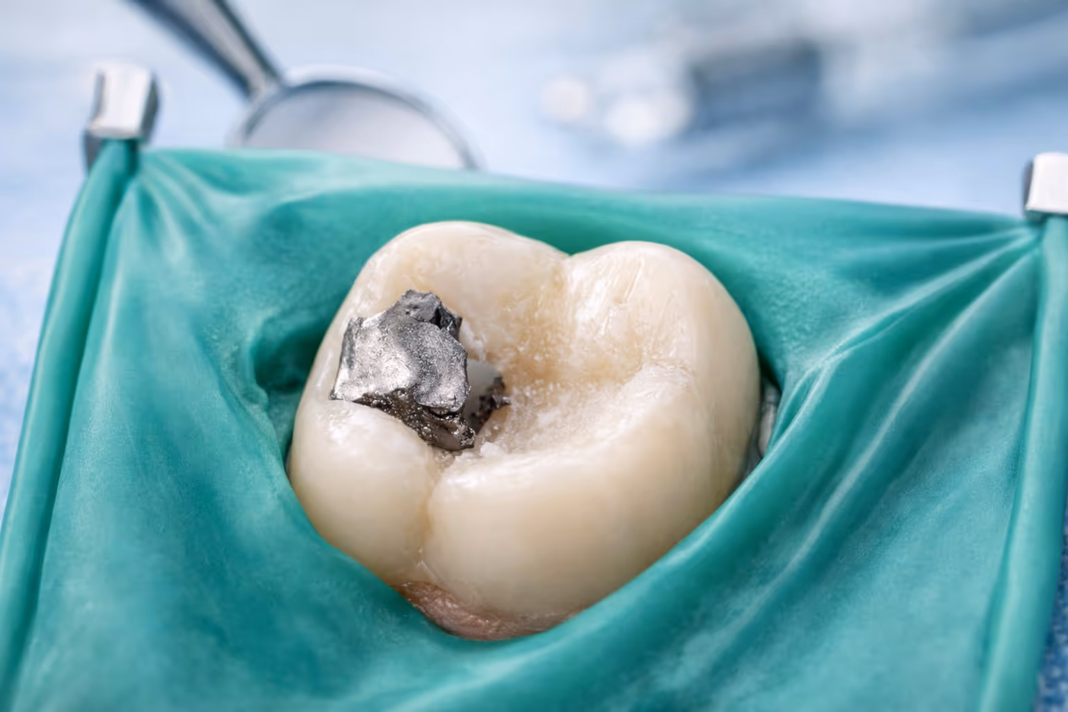 Safe Amalgam Filling Removal at Lakevie Dental