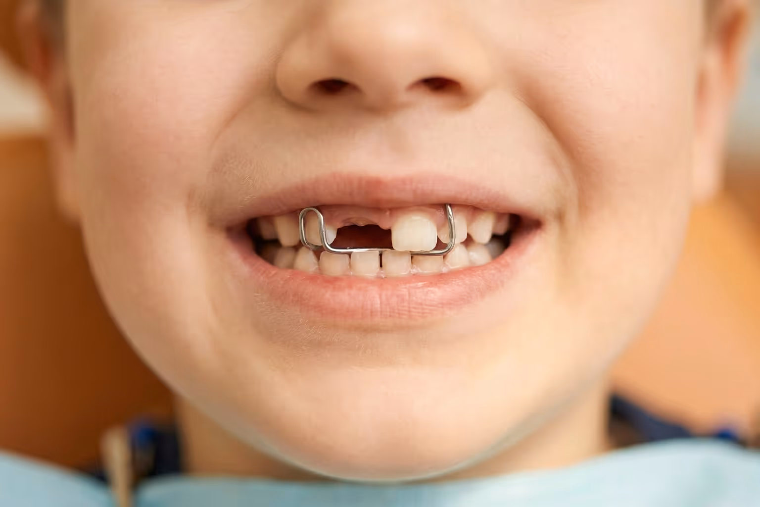 Space Maintainers at Lakevie Dental