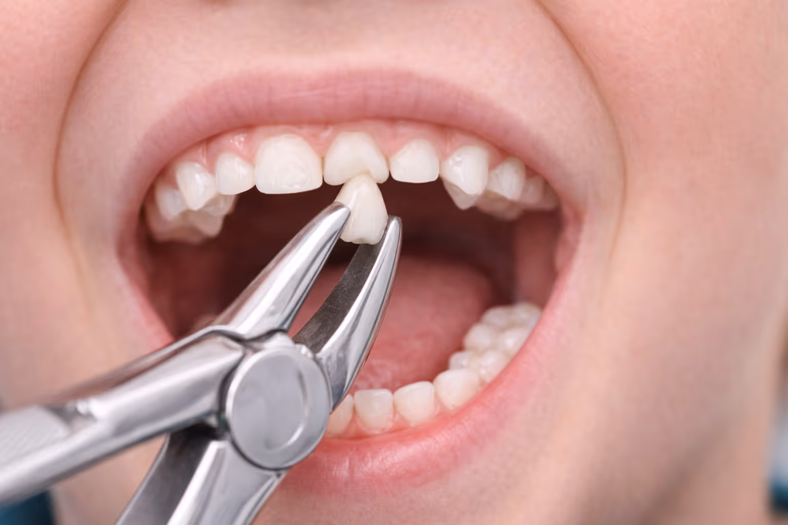 Supernumerary Tooth Removal at Lakevie Dental